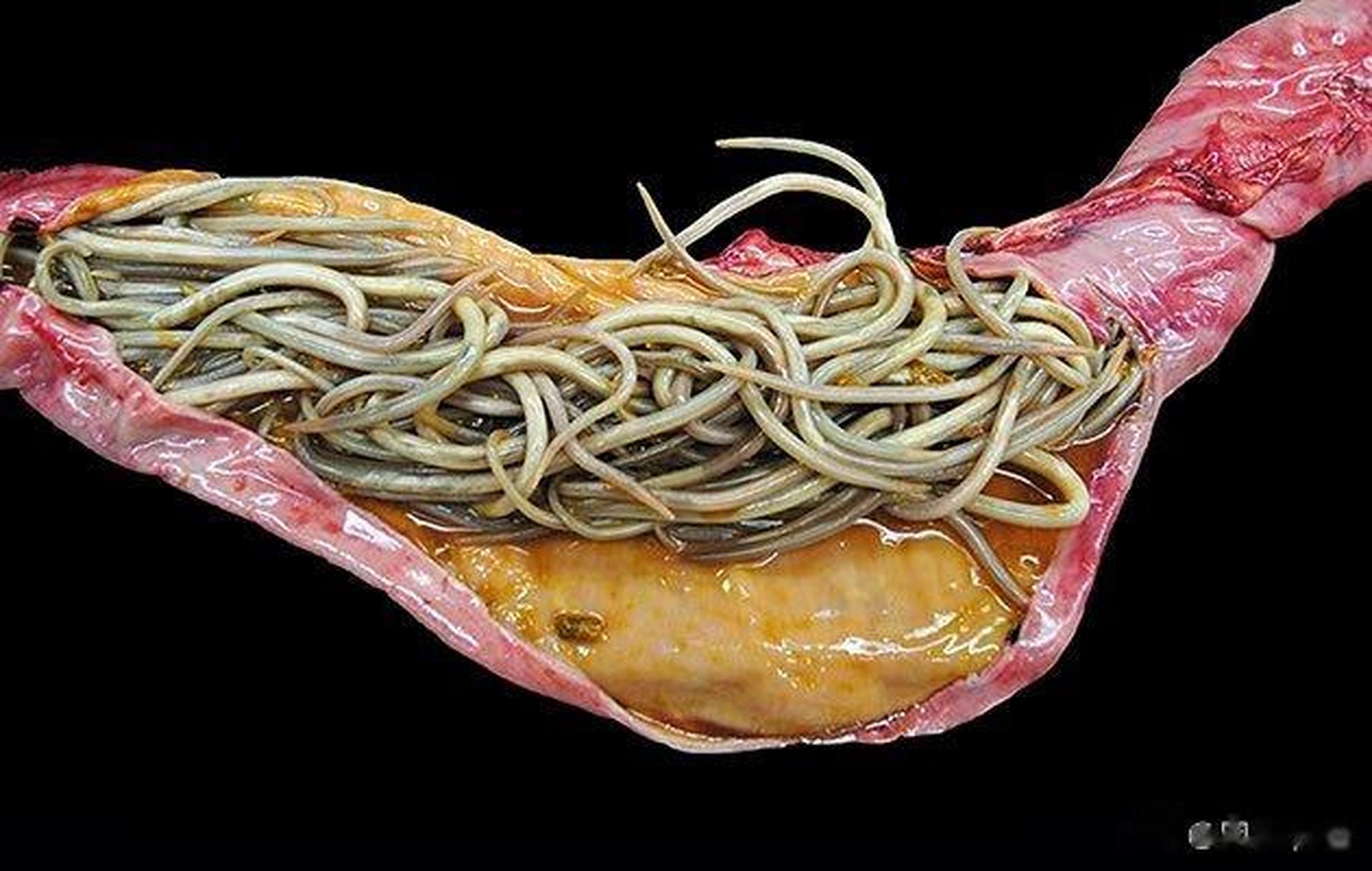 越来越多医生跳出来说癌症是寄生虫导致.