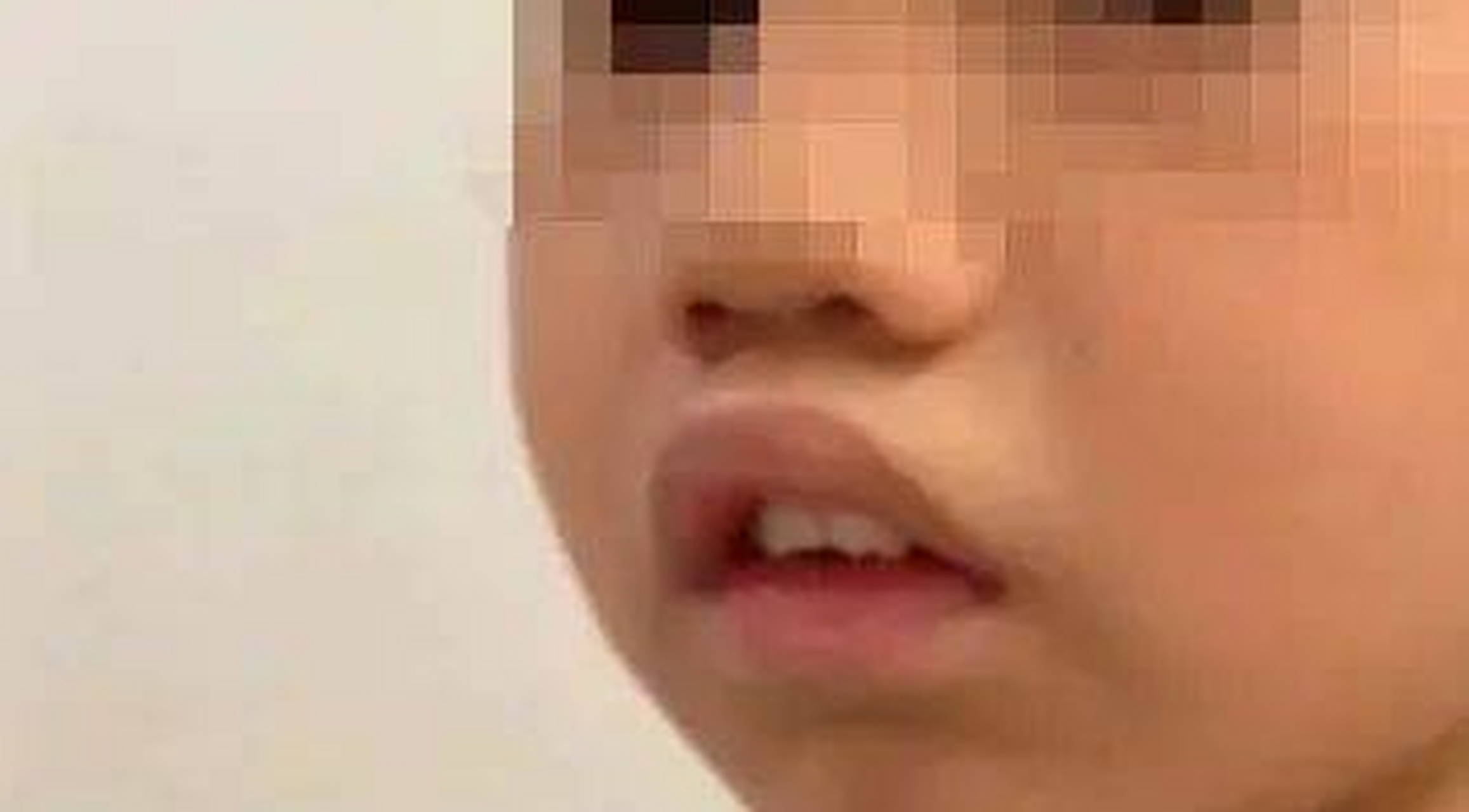 儿童腺样体面容几乎不可逆,出现这四大症状要警惕 近几年,很多家长都