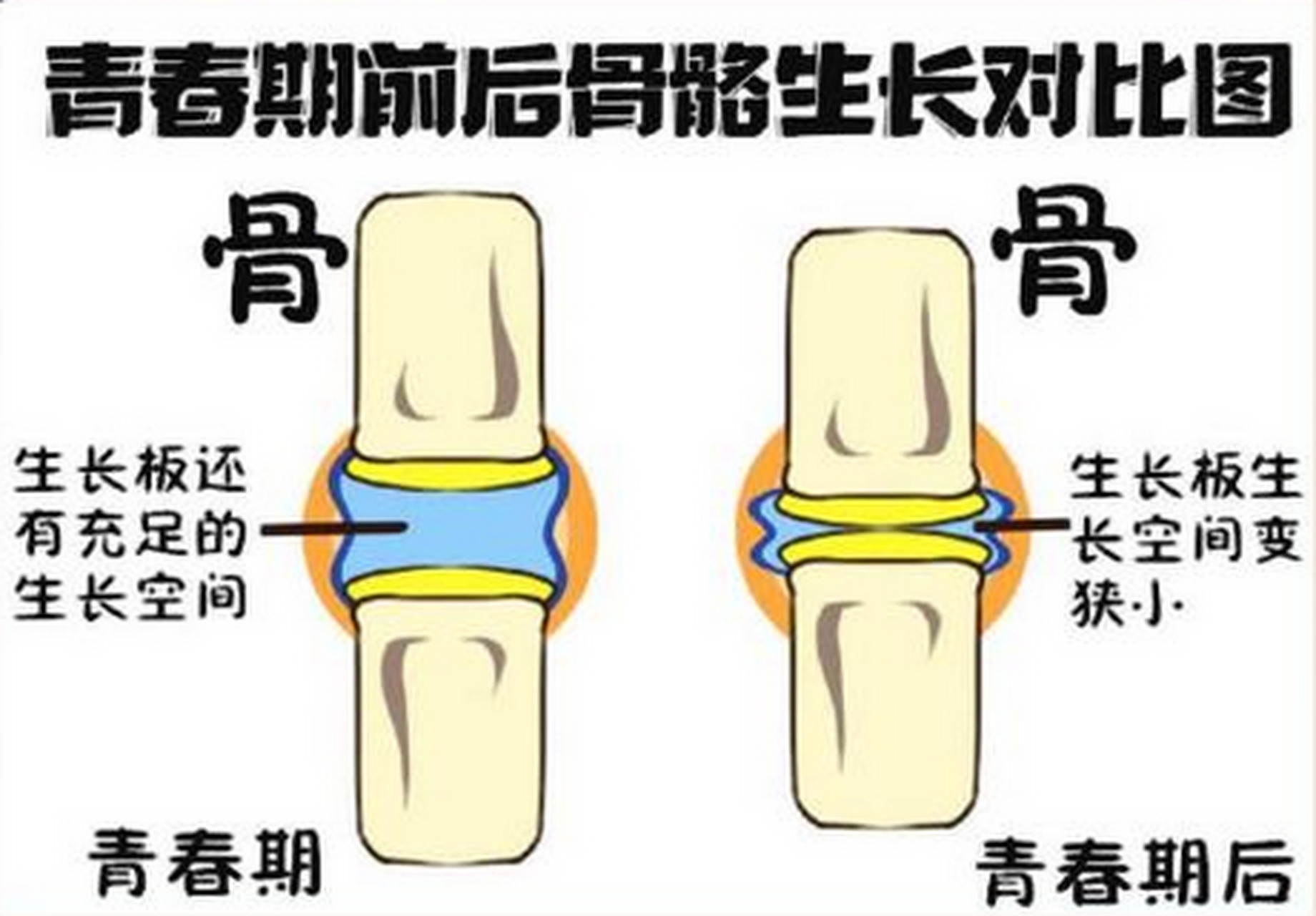 趁着孩子青春期骨骺线未闭合,请抓紧追高   小王,男孩,13岁,身高155