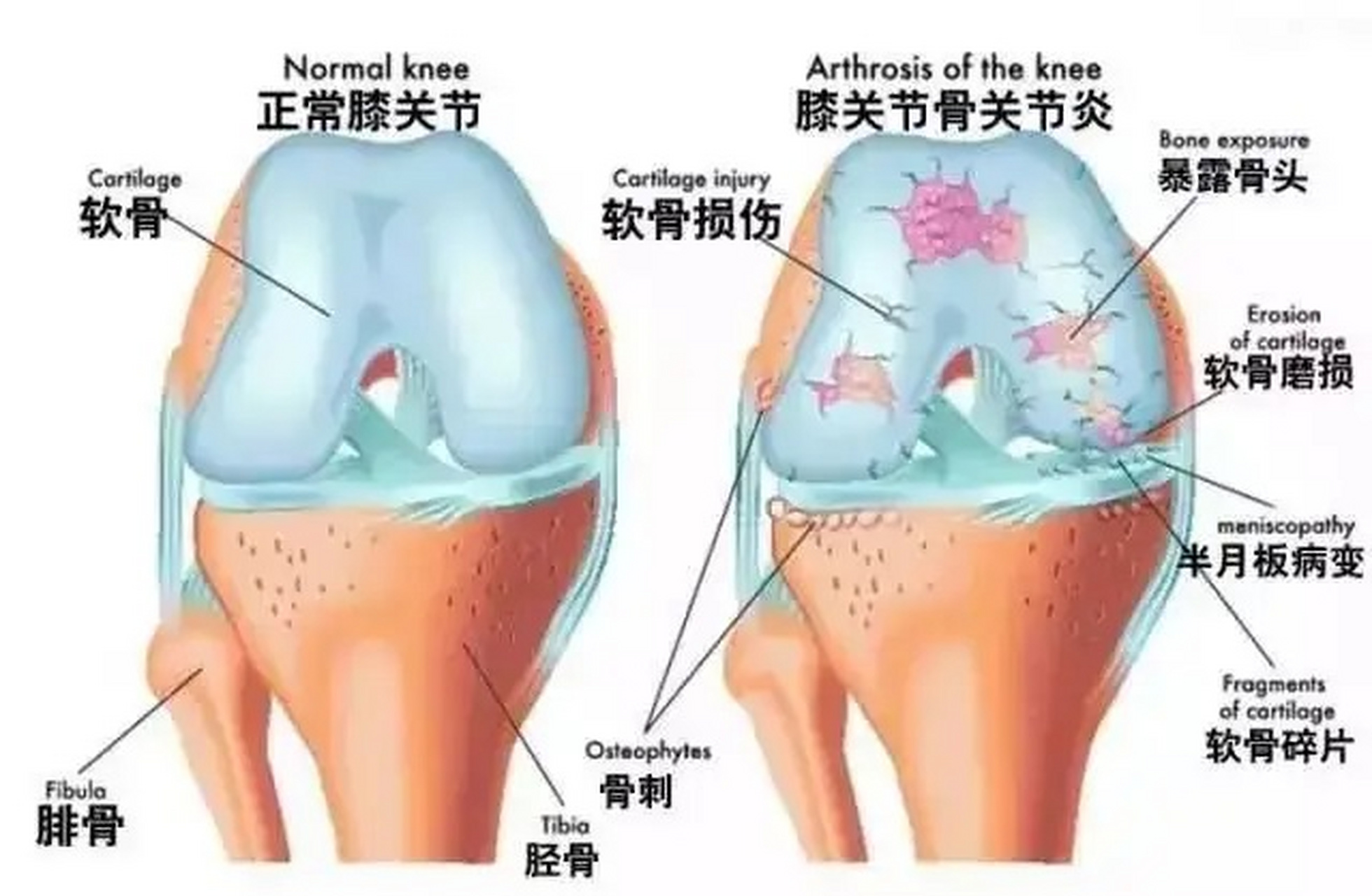 胫骨骨质增生图片