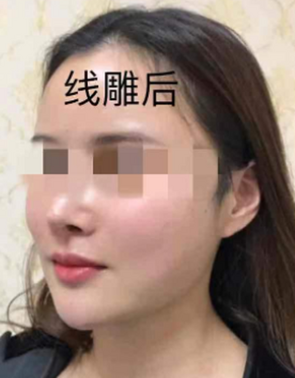 大家都知道线雕的好处,却没人告诉你们线雕也有副作用,今天我就来告诉