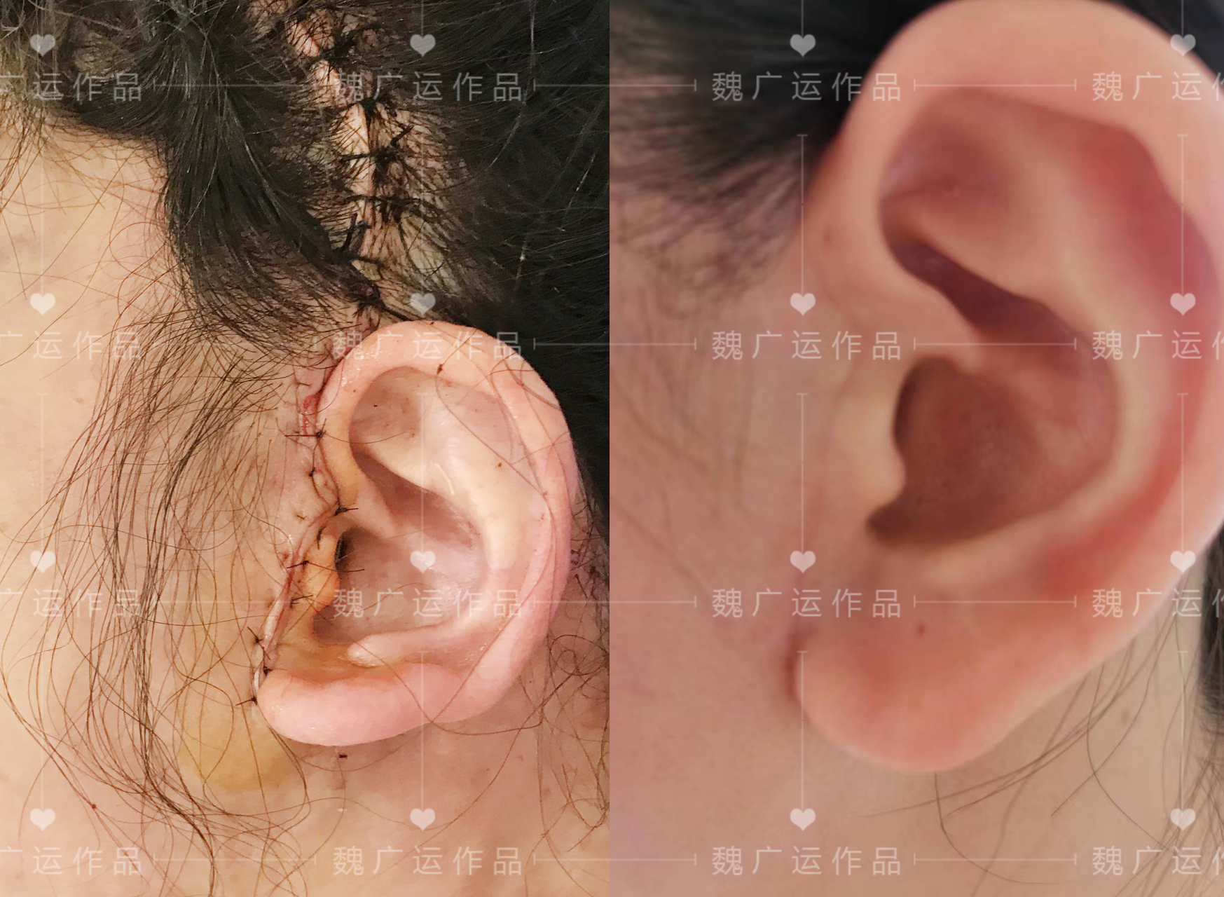 在手术之初,切口痕迹可能会明显可见,缝线清晰,切口周围发红,滞胀