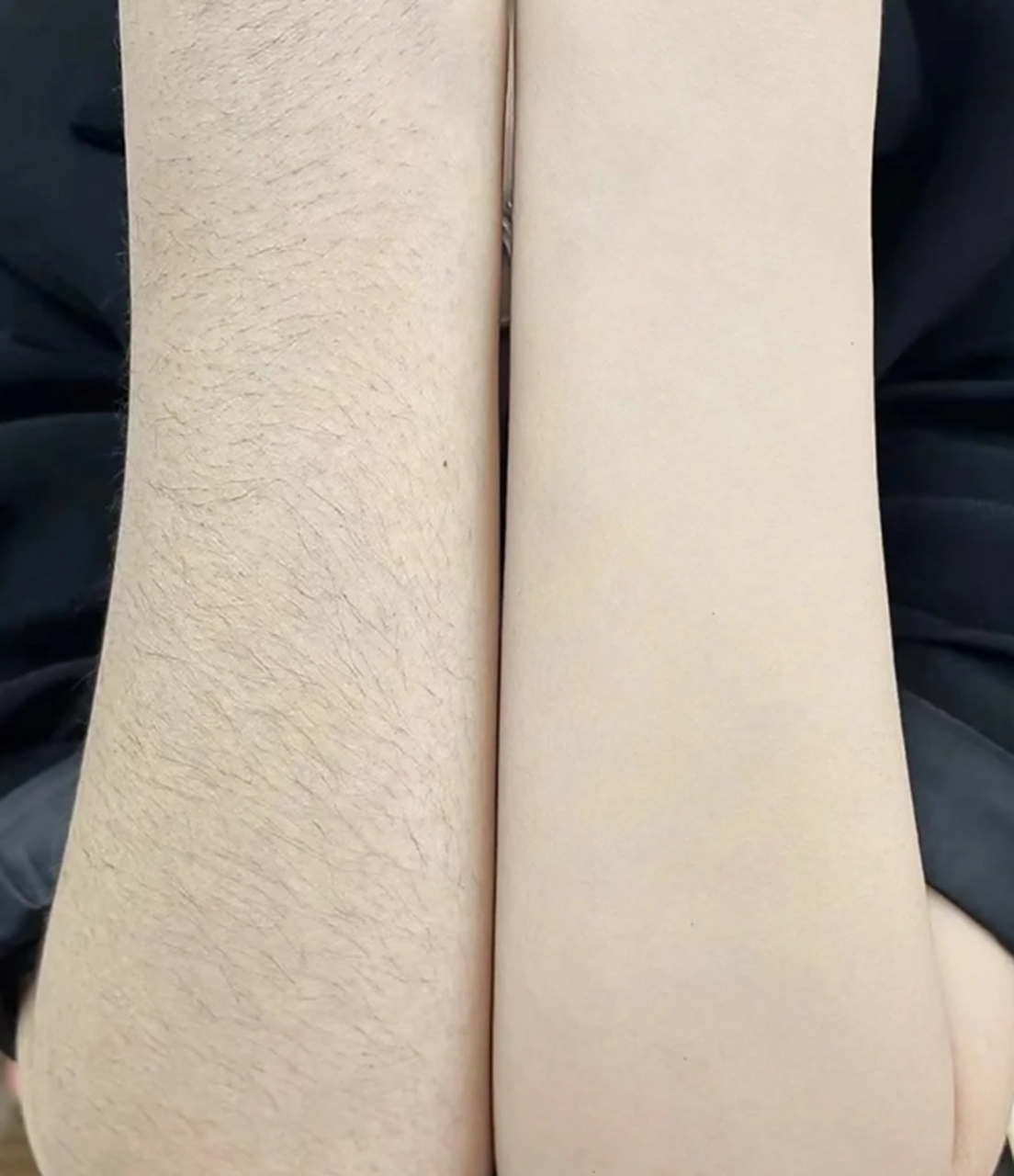 脱毛是一种常见的美容方法,可以去除多余的体毛,使皮肤更加光滑和细腻