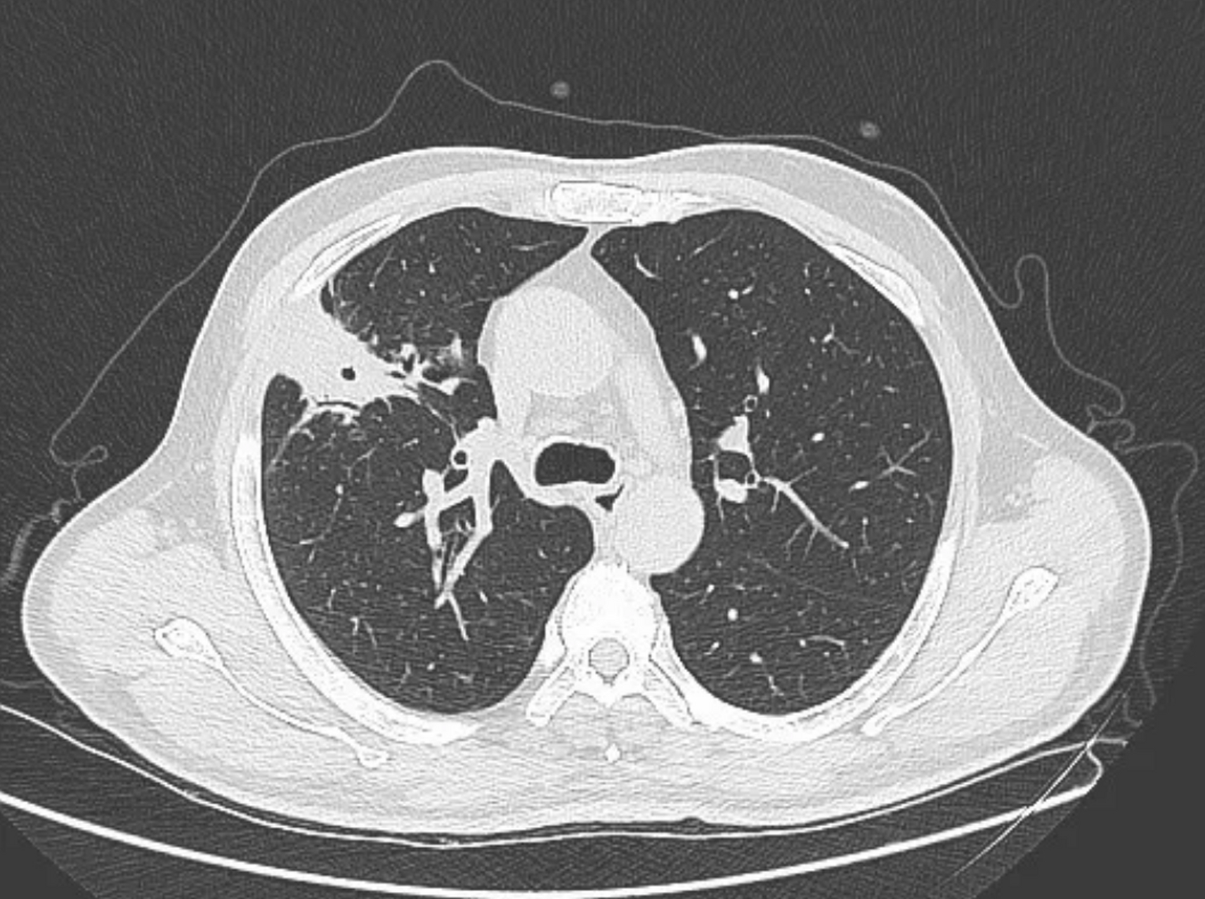 一个肺脓肿患者,差点被误诊为肺癌 这个病人50岁,咳嗽,咳痰四五天了