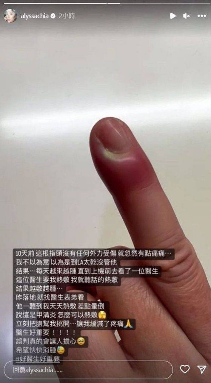 贾静雯患甲沟炎手指红肿剧痛 医生误判让其热敷结果更严重  贾静雯在