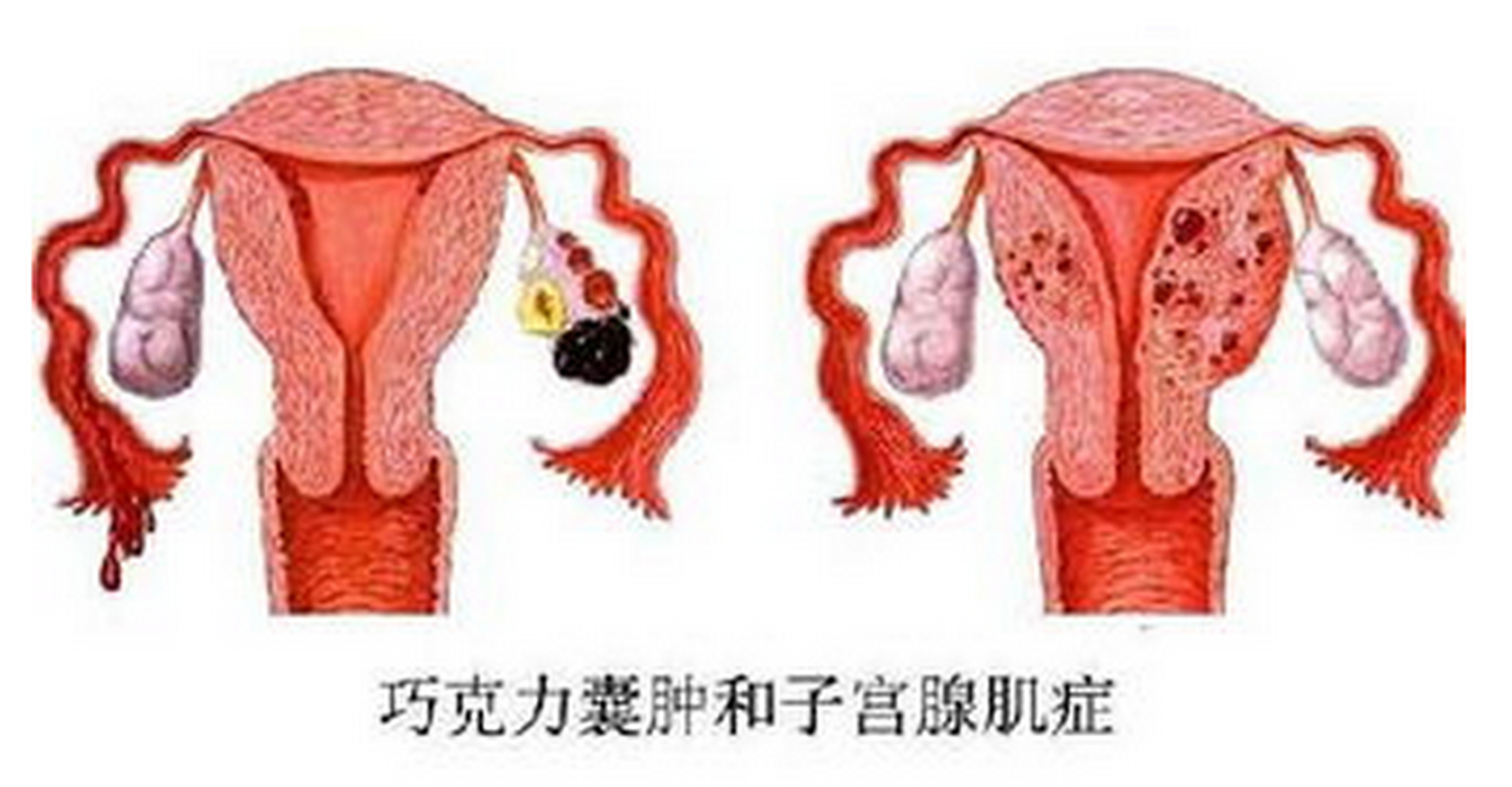 子宫腺肌病是指子宫内膜向子宫肌层良性浸润并在其中弥漫性生长