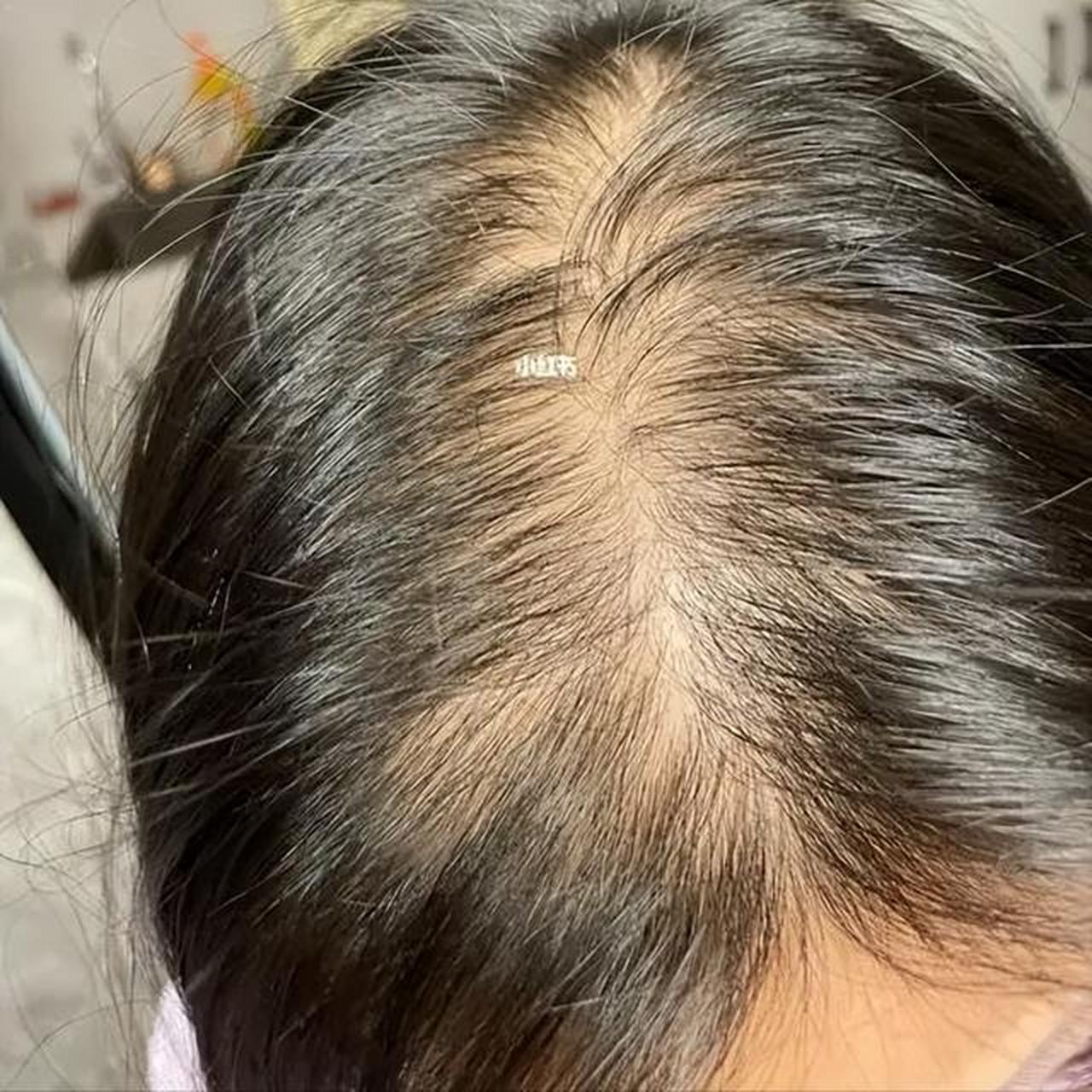 女性会不会得脂溢性脱发?