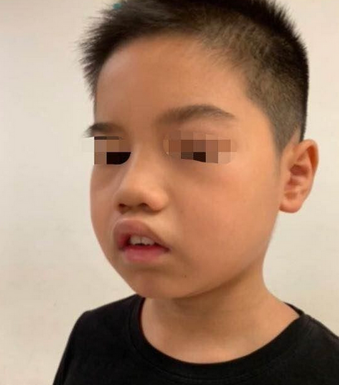 男孩夜间呼吸困难,容貌"变丑",这个病家长需注意