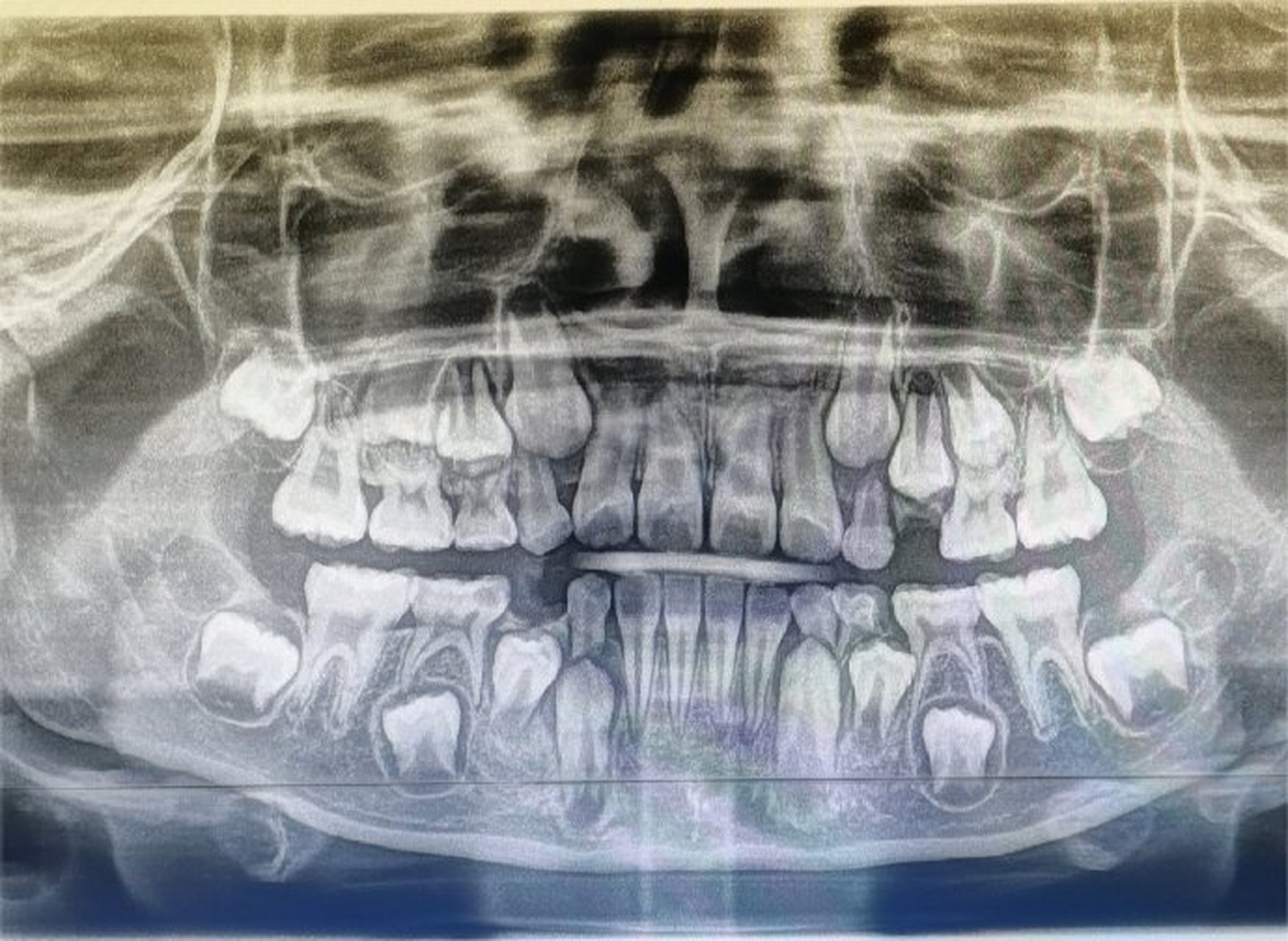 换牙期小朋友的牙片可以清楚看到有四排牙齿 (还有两颗是长在眼睛下方