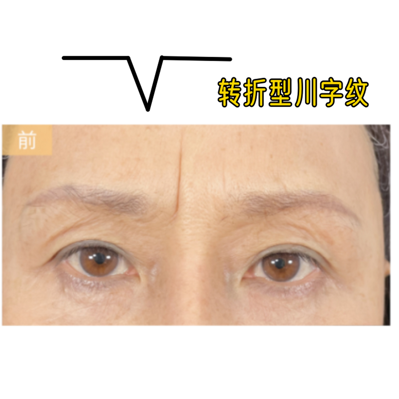 古人云:"印堂悬针纹粗显,刑夫斩子灾必见".