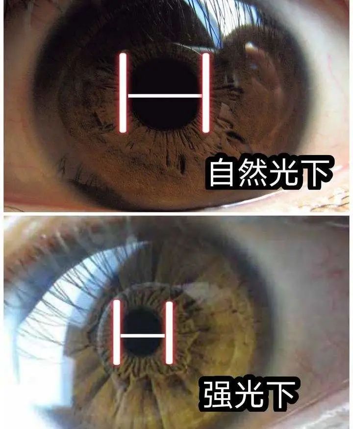 散瞳后瞳孔大小标准图图片