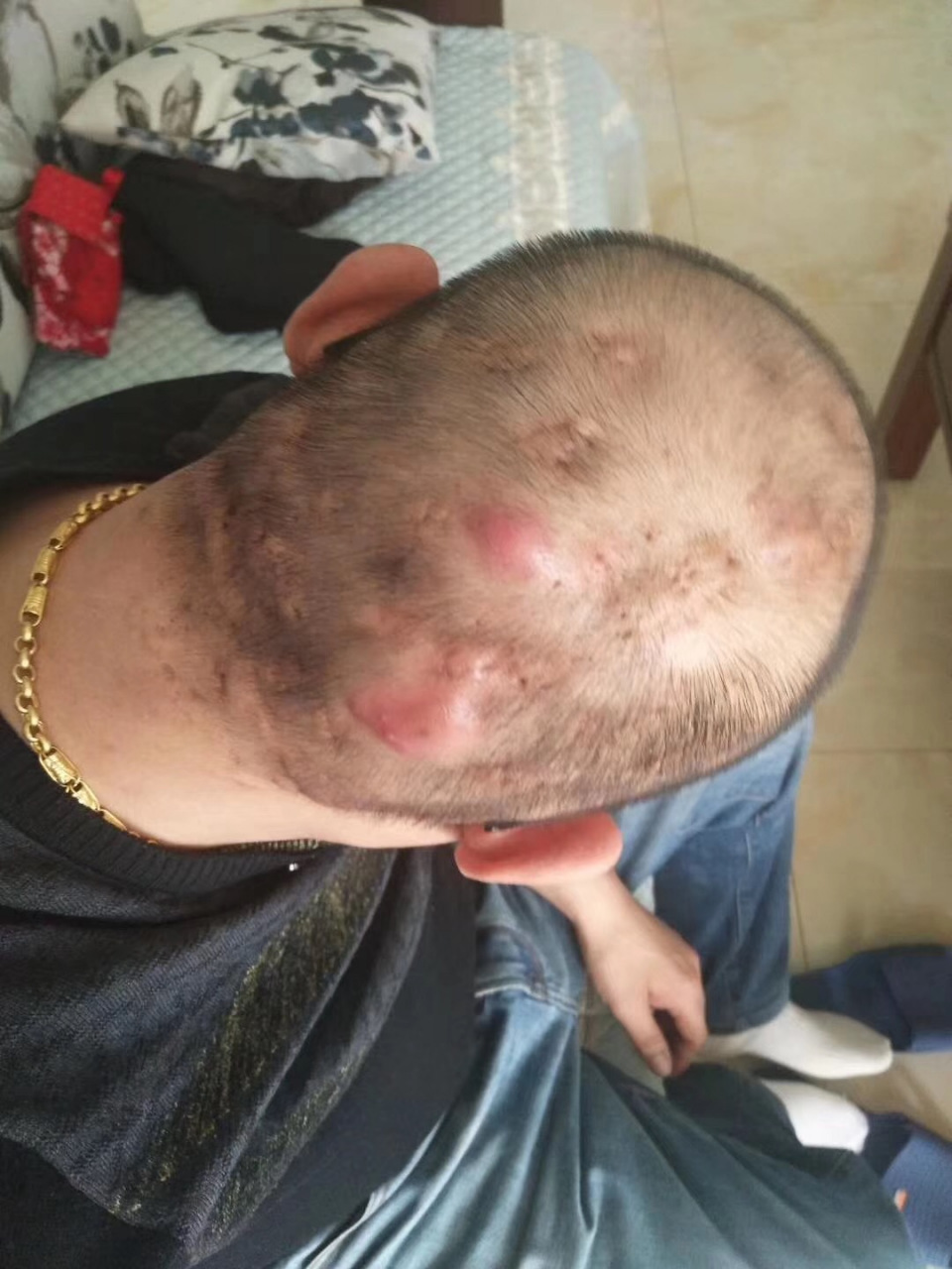 这些习惯导致20多岁胖小伙患上穿掘性毛囊炎. 一个真实的案例.