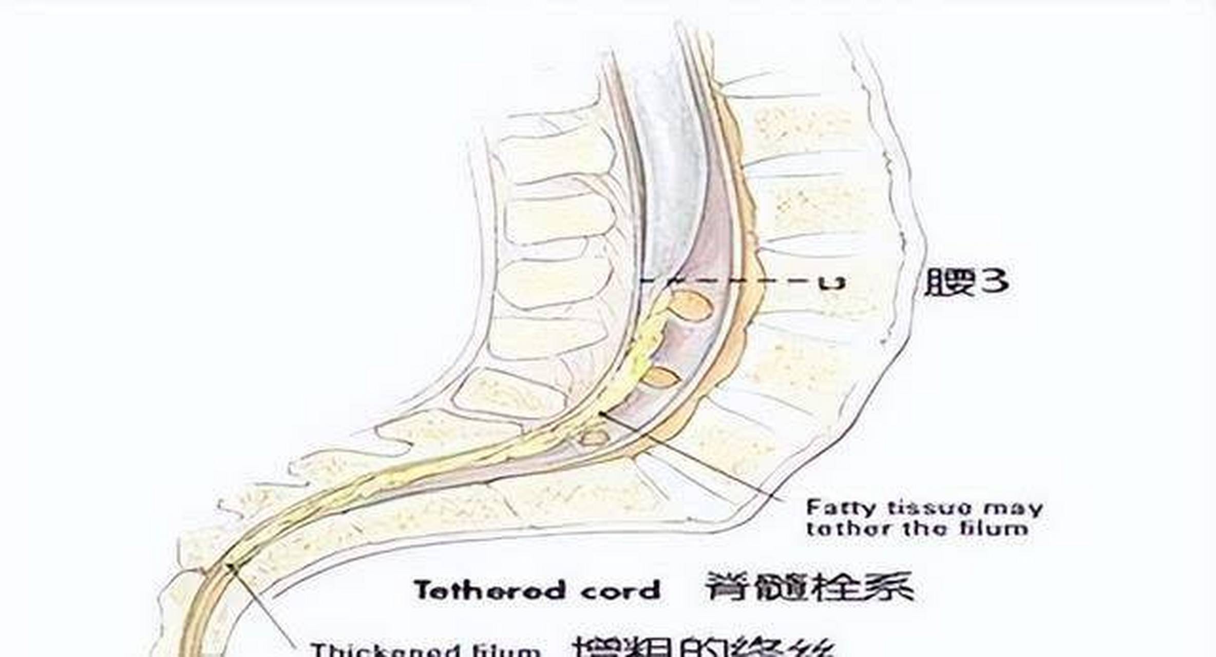 小儿脊髓栓系图片图片