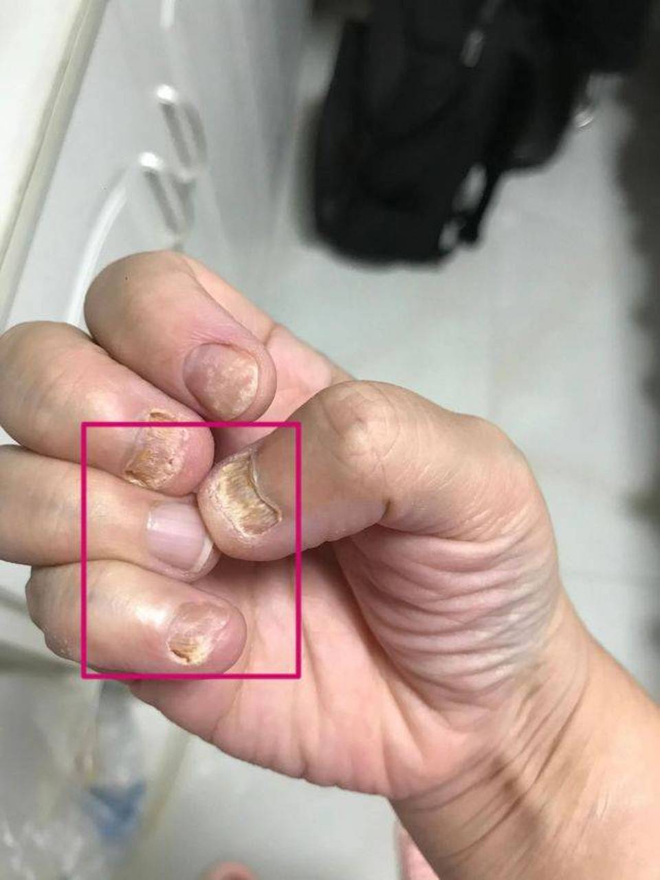 我之前因为手指手指指甲受伤,没有处理好让真菌钻了空子,得了灰指 