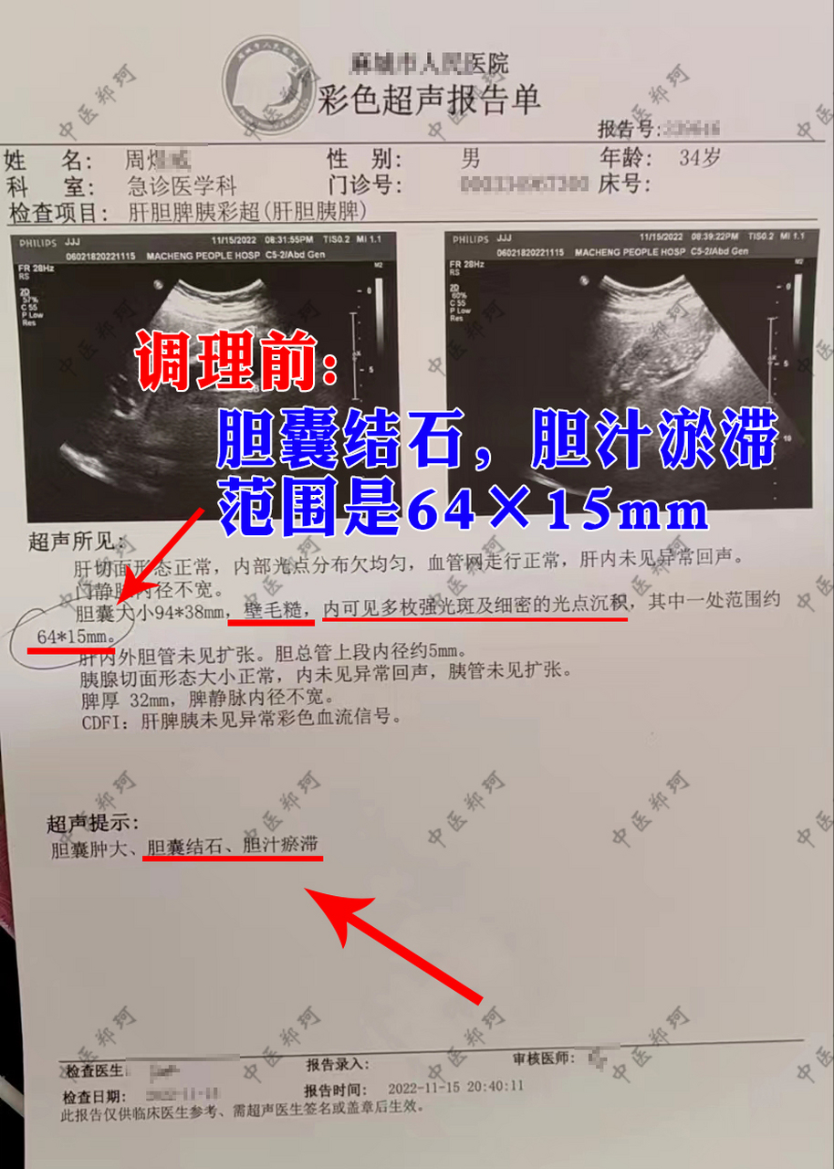 胆结石患者周先生,来诊时彩超报告提示:胆结石,胆汁淤滞,范围是64