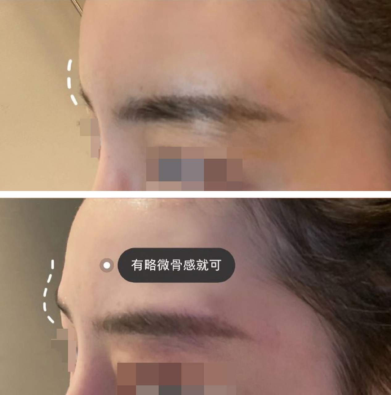 老路:假体垫眉弓,术后是有可能会出现"发红"现象的.