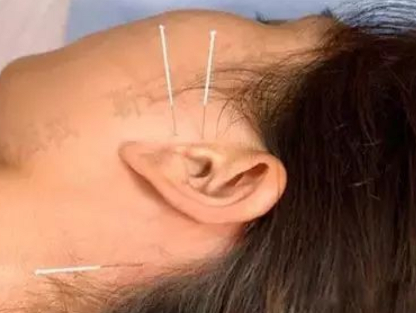 耳三针,治疗各种耳聋,记住这三个"地方"!