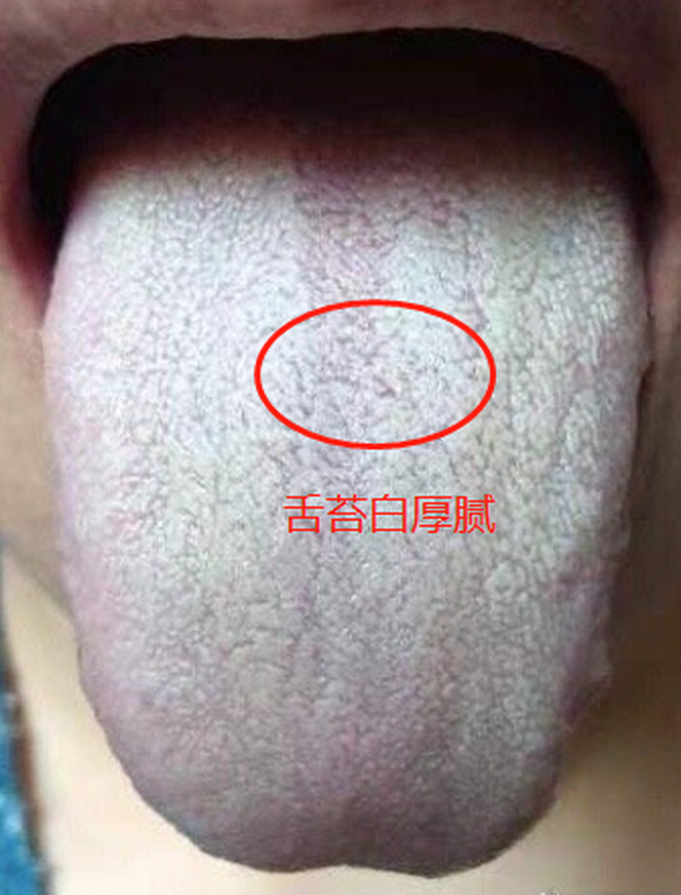 寒性舌苔的图片图片