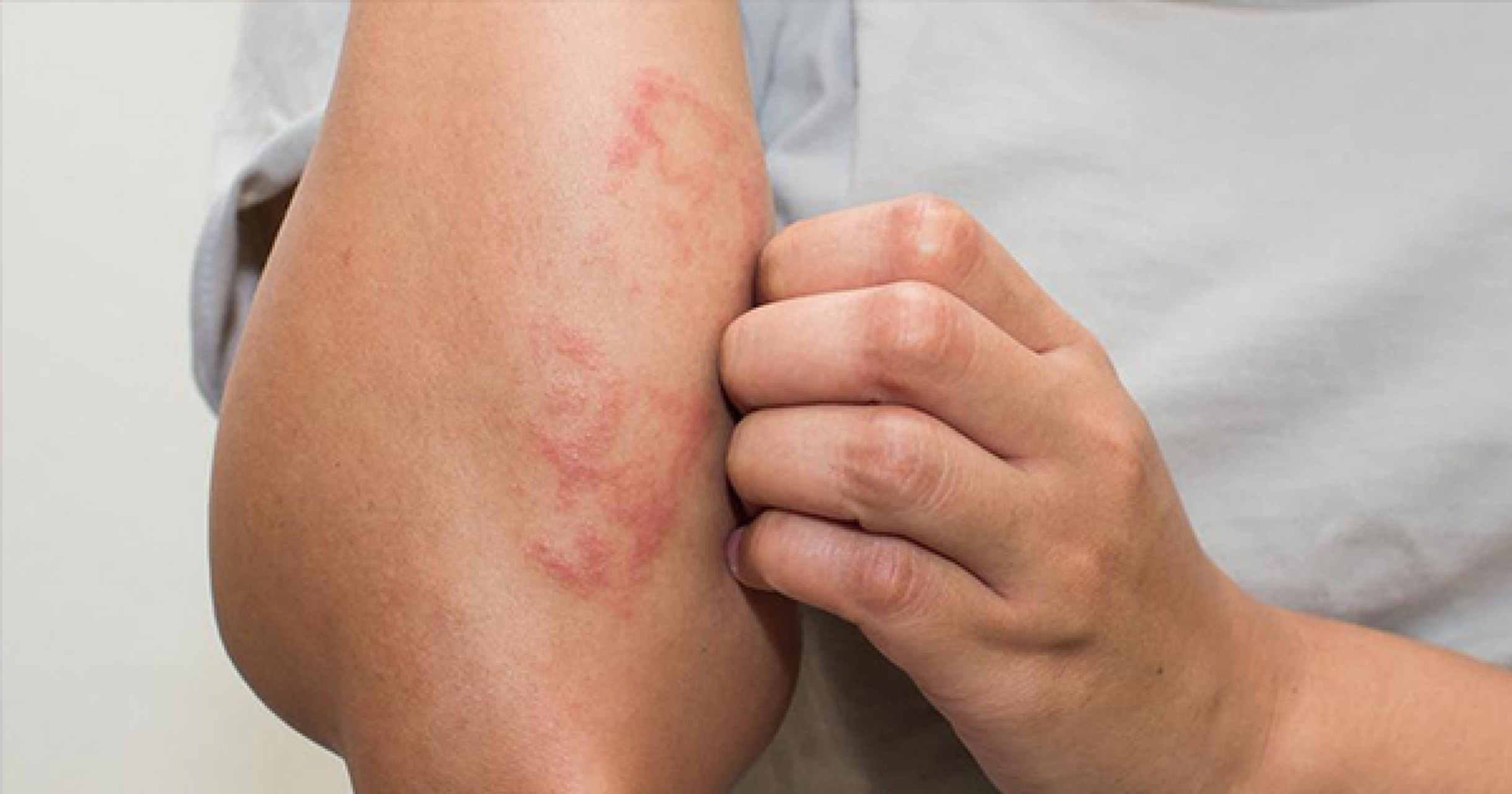 湿疹的忌口食物有哪些#   湿疹常见于皮肤病,症状包括皮肤发红,瘙痒