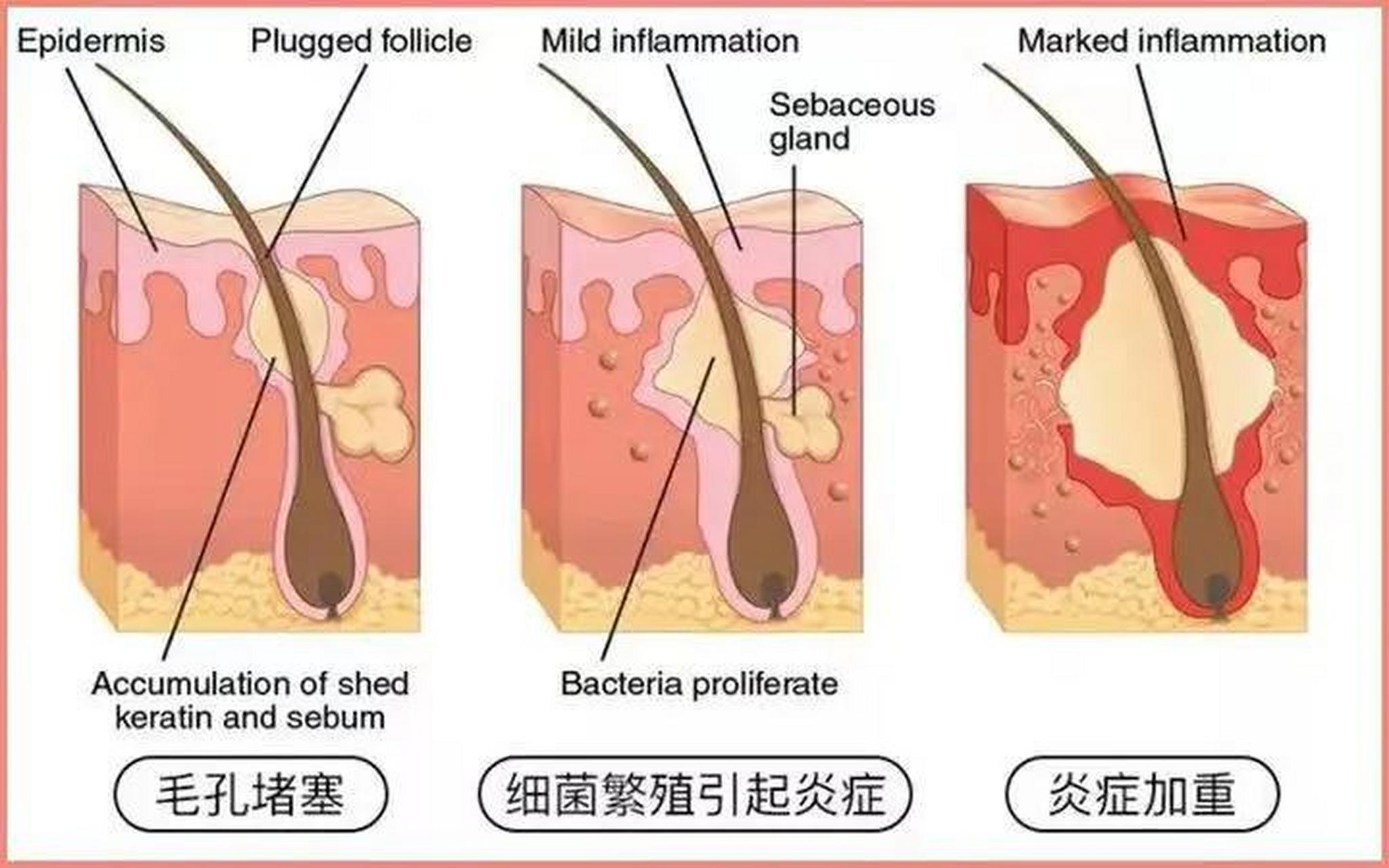 痤疮的学术名称为寻常痤疮,皮损好发于面颊,额部,也可以出现在躯干