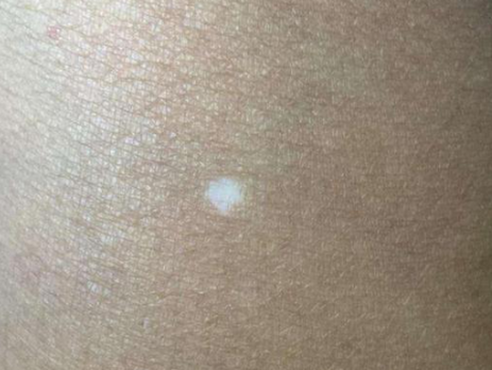 今天跟大家讲讲老年性白斑的问题:  老年性白斑多见于45 岁以上敌中