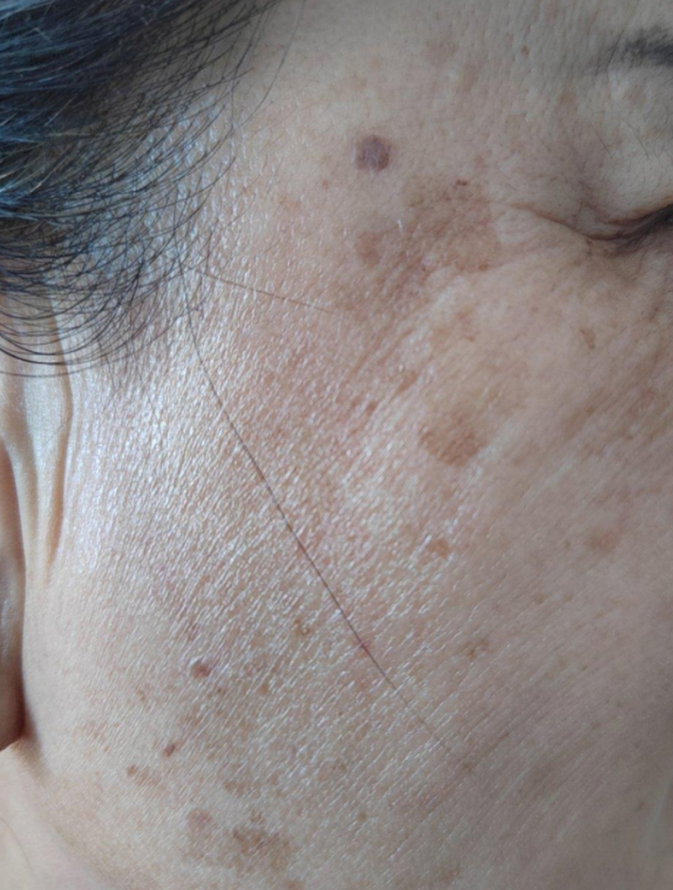 来看看用激光治疗老年斑后的效果怎么样吧.#老年斑