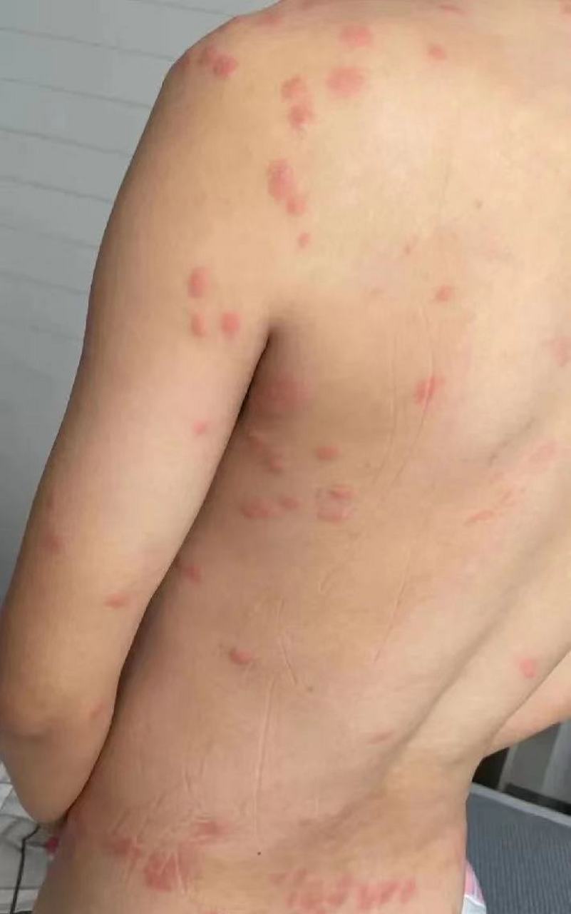 带状疱疹轻的时候,有时候确实不太容易诊断,尤其是不疼的,疹子特别