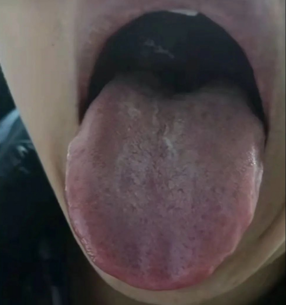 典型的肝郁脾虚而导致肺气不足的舌象  这个患者男