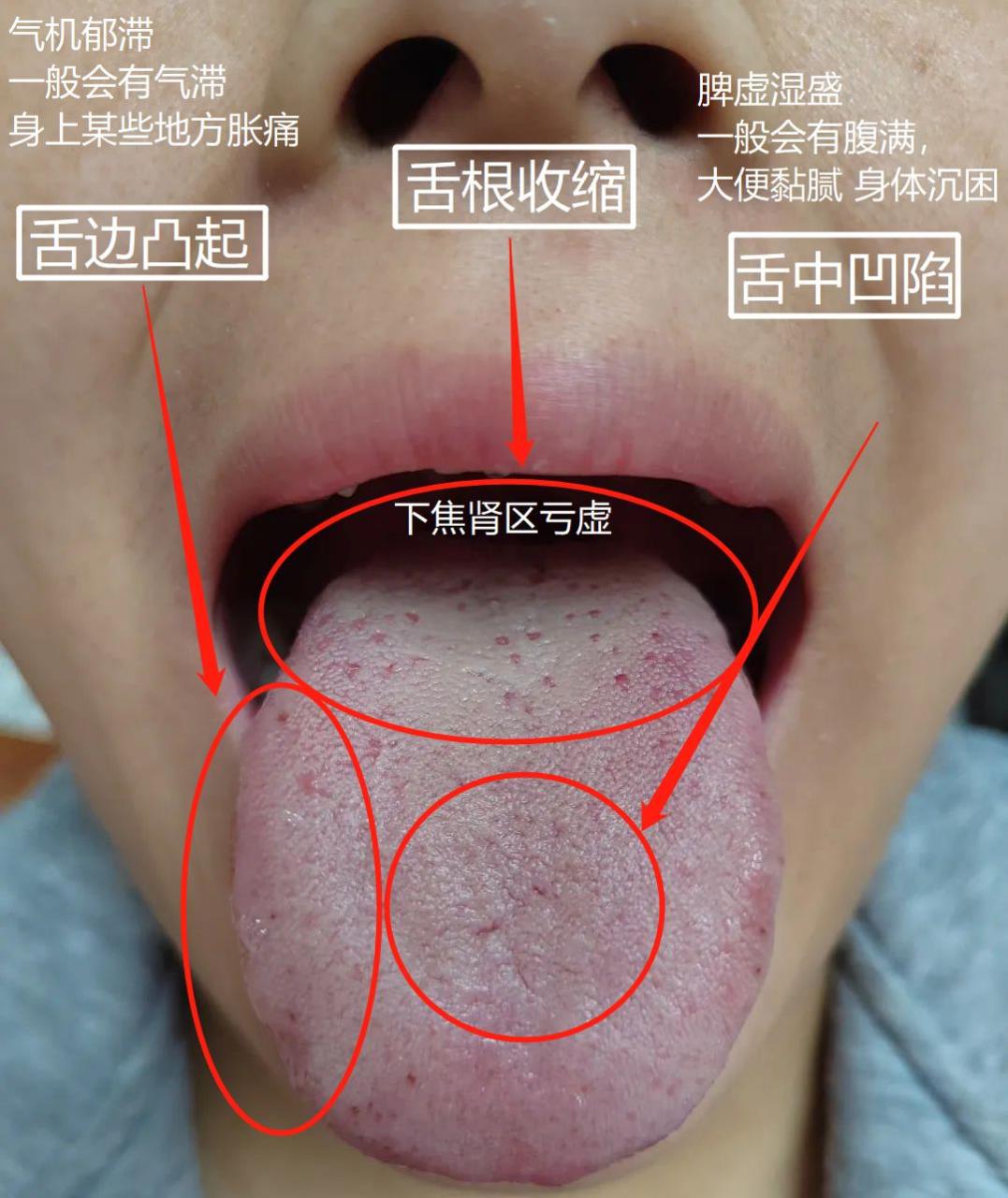 像这一位朋友,舌苔厚发黄,舌质颜色暗紫,舌根收缩 标记1:舌两侧凸起微