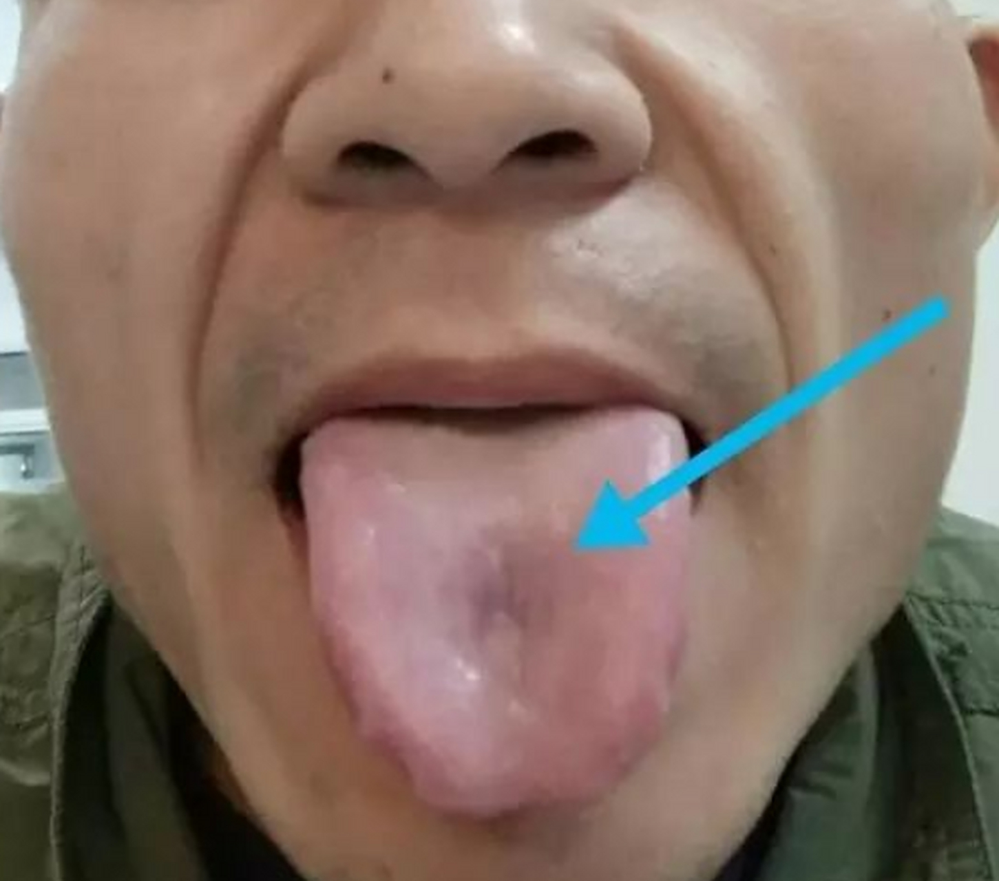 看看这个大叔,舌头中间一个坑,深深的坑 常常有胃痛症状,既往有胃溃疡