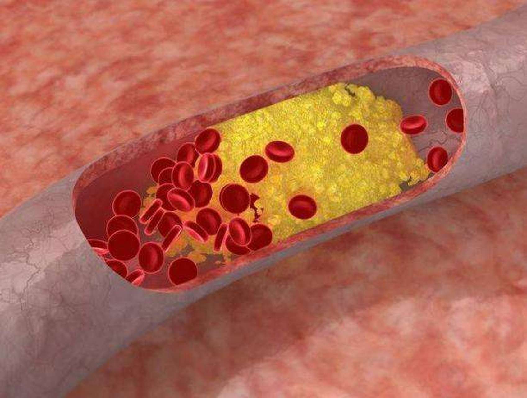 动脉粥样硬化是一种全身性血管疾病,常常会容易引起冠心病,心梗等
