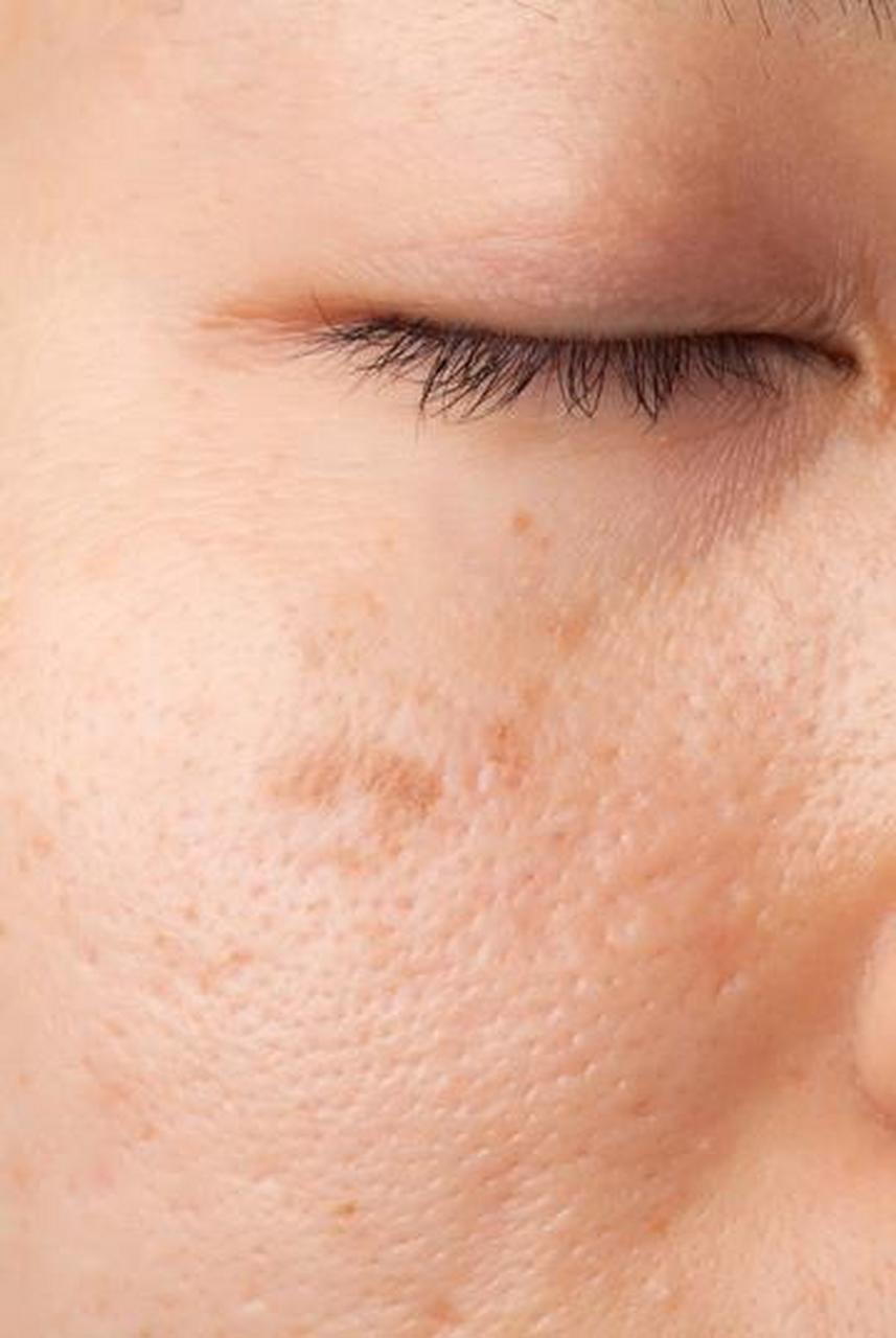 淡化疤痕最好的方法目前最有效的 涂抹疤痕凝胶的原理是通过活性成分