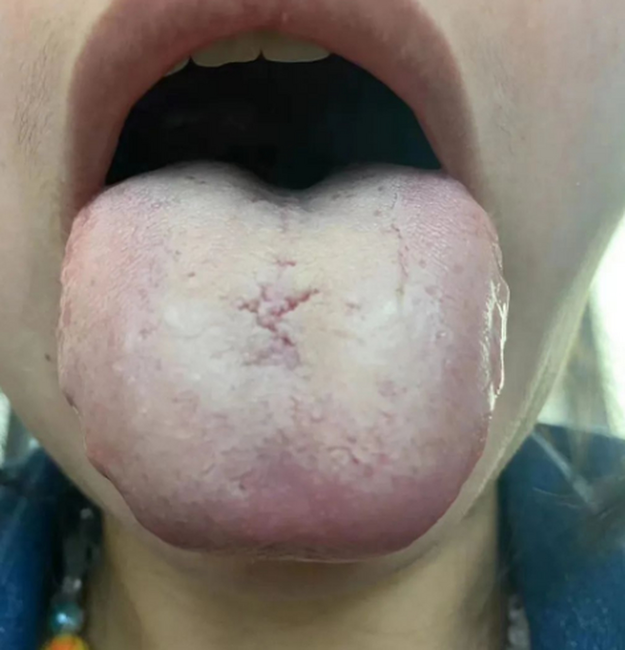 痰湿的症型 所以他出现了嘴巴黏,头昏沉,容易贪睡,腹胀等等这样的症状