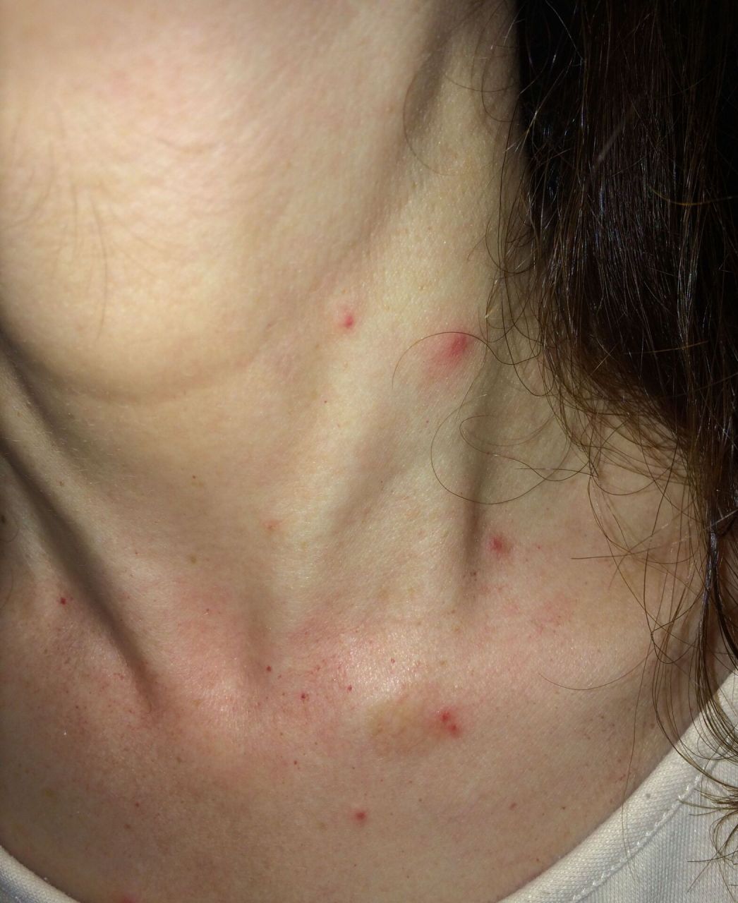 小女孩今年25岁,据她描述,最近一段时间发现身上开始出现一个个小红点