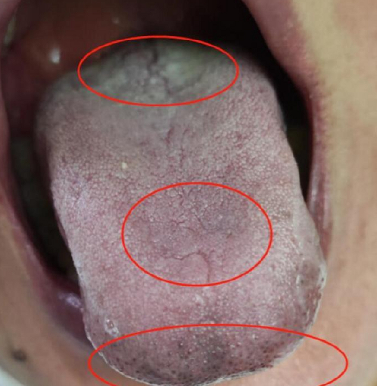 肝胆舌两边有瘀点图片图片