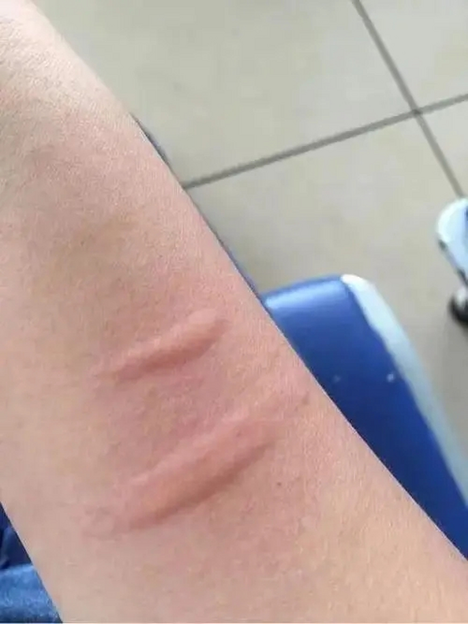 可能会导致窒息 荨麻疹民间也俗称"风疙瘩", 据