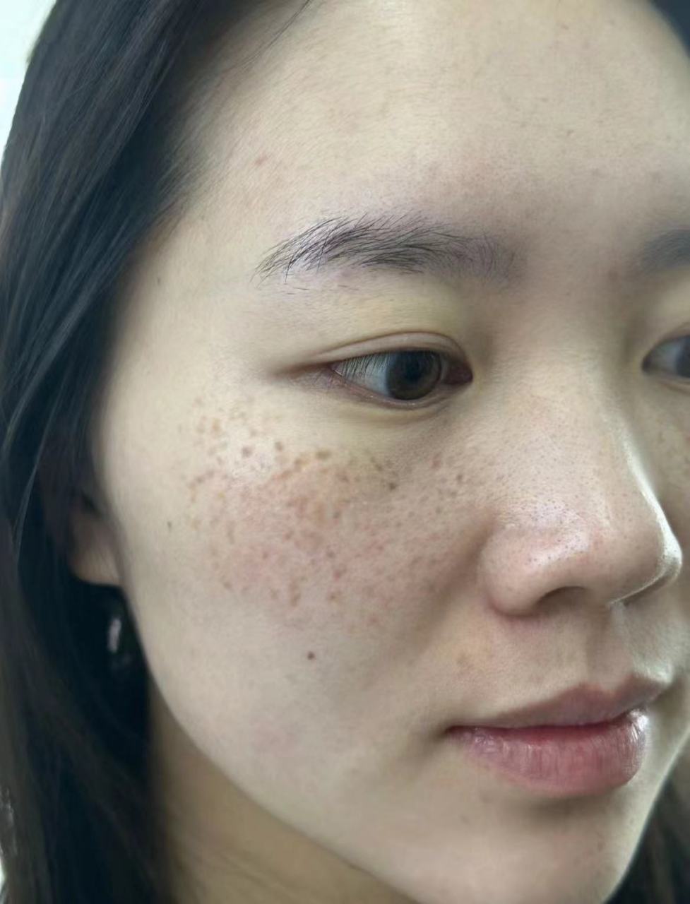 医美科普挑战赛#  脸上出现斑点是很多人的烦恼,但要想有效地解决这