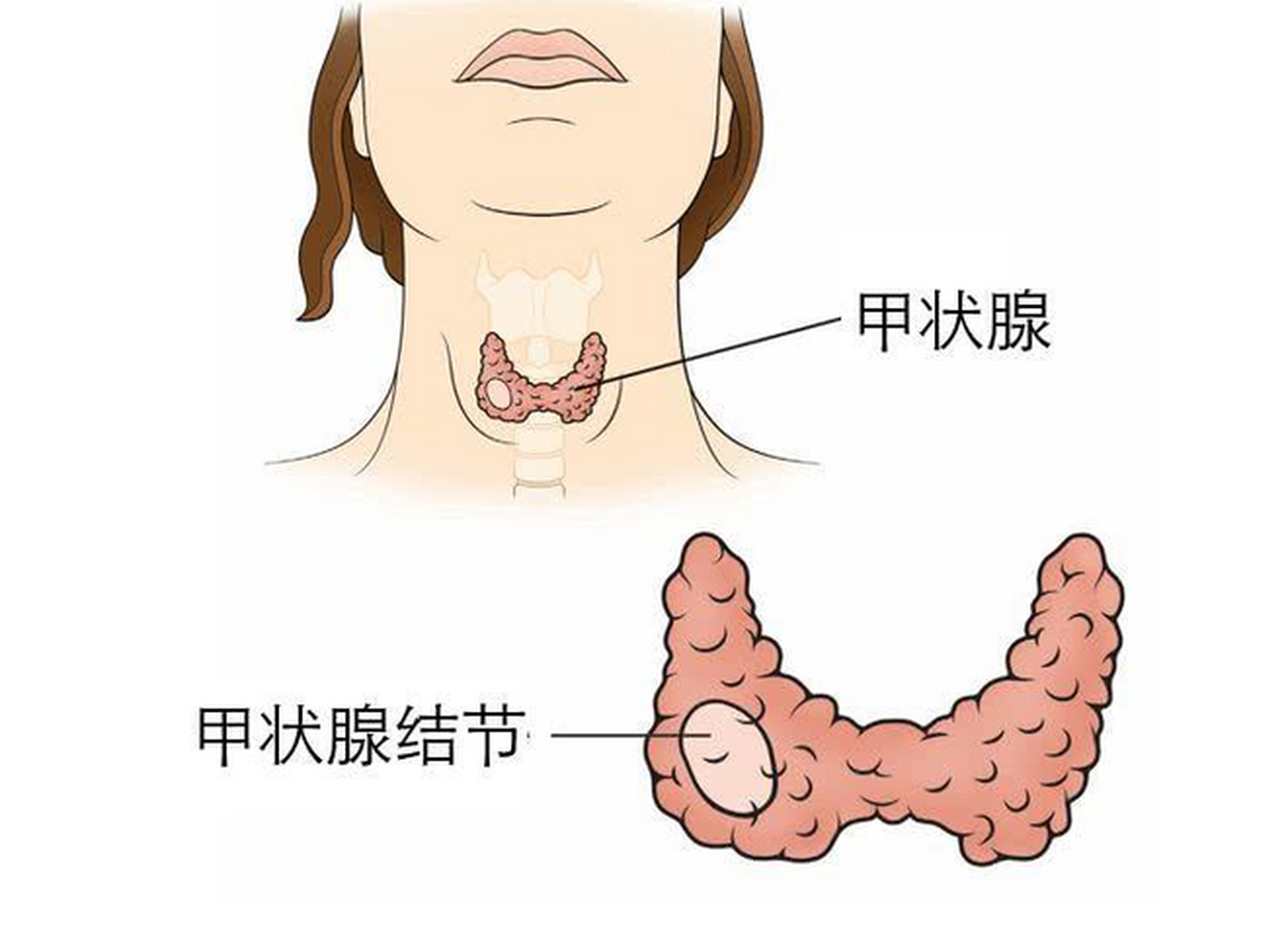 治疗甲状腺结节,切忌治标不治本!