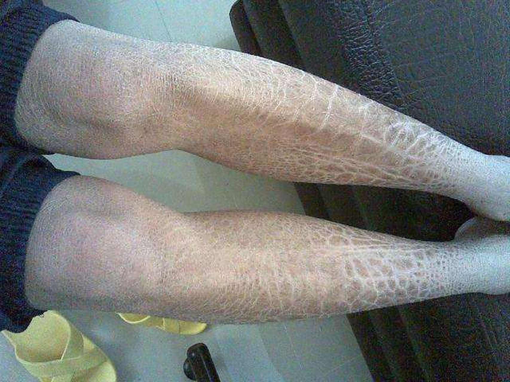 小腿皮肤像"鱼皮",这个方法简单处理 小腿的皮肤像鱼鳞一样干燥,脱屑