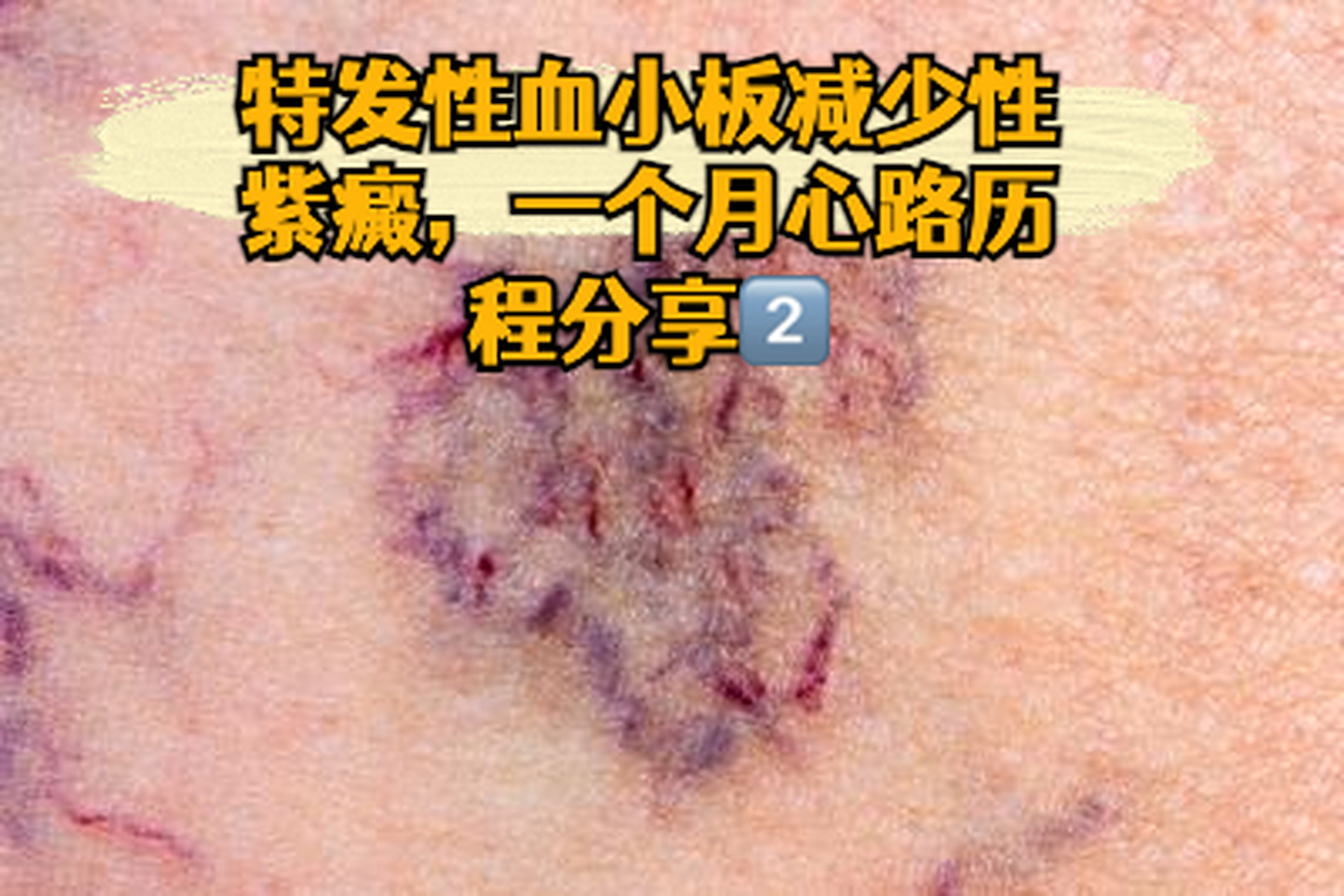 [太阳]特发性血小板减少性紫癜,一个月心路历程分享21566  因为第