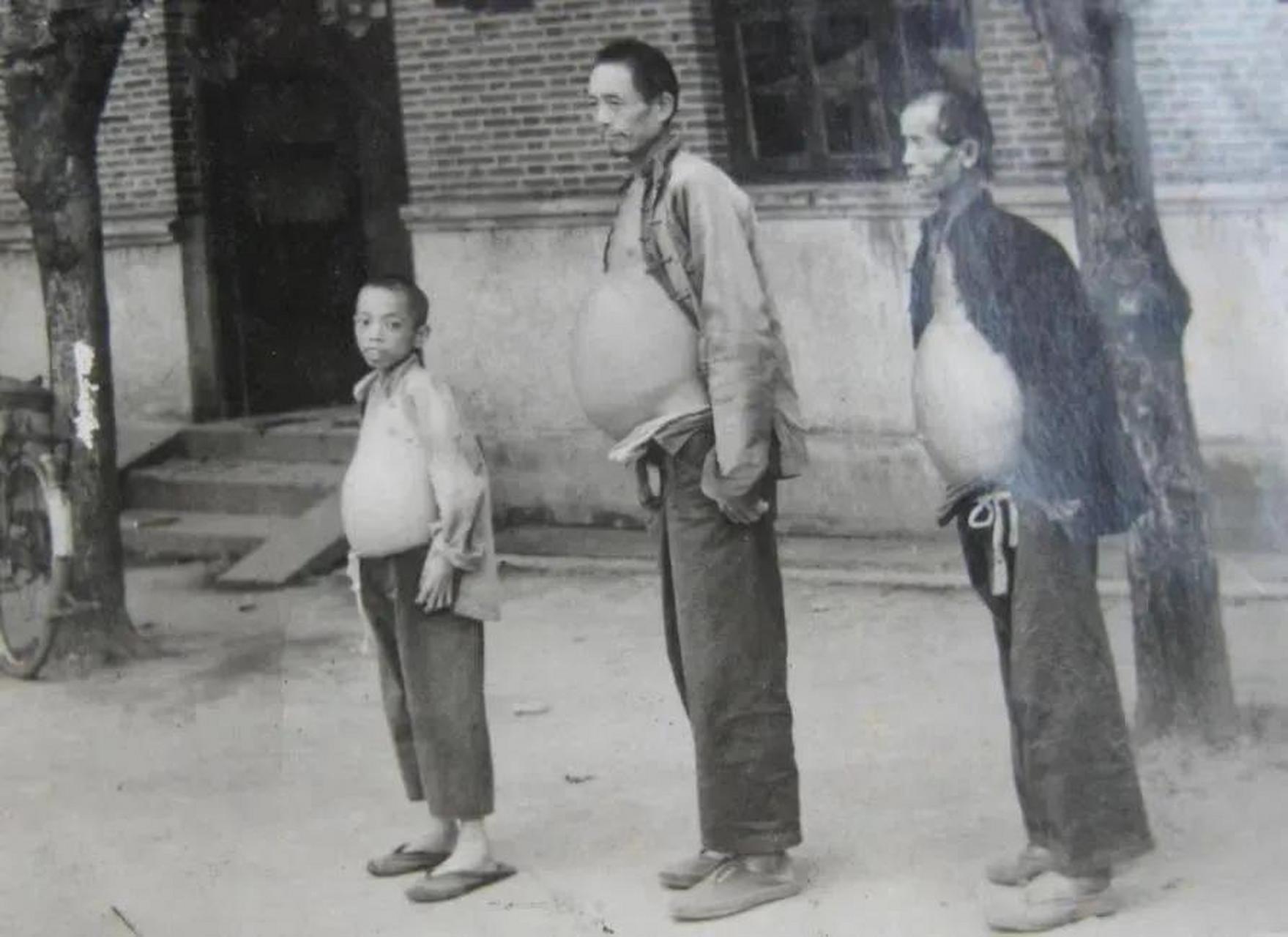1956年,江苏镇江发生了一起罕见的吸血虫病病例,祖孙三代相继感染了