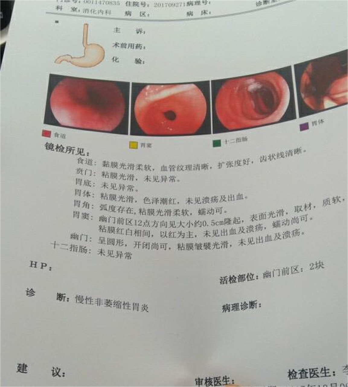 糜烂性胃炎怎么治疗图片