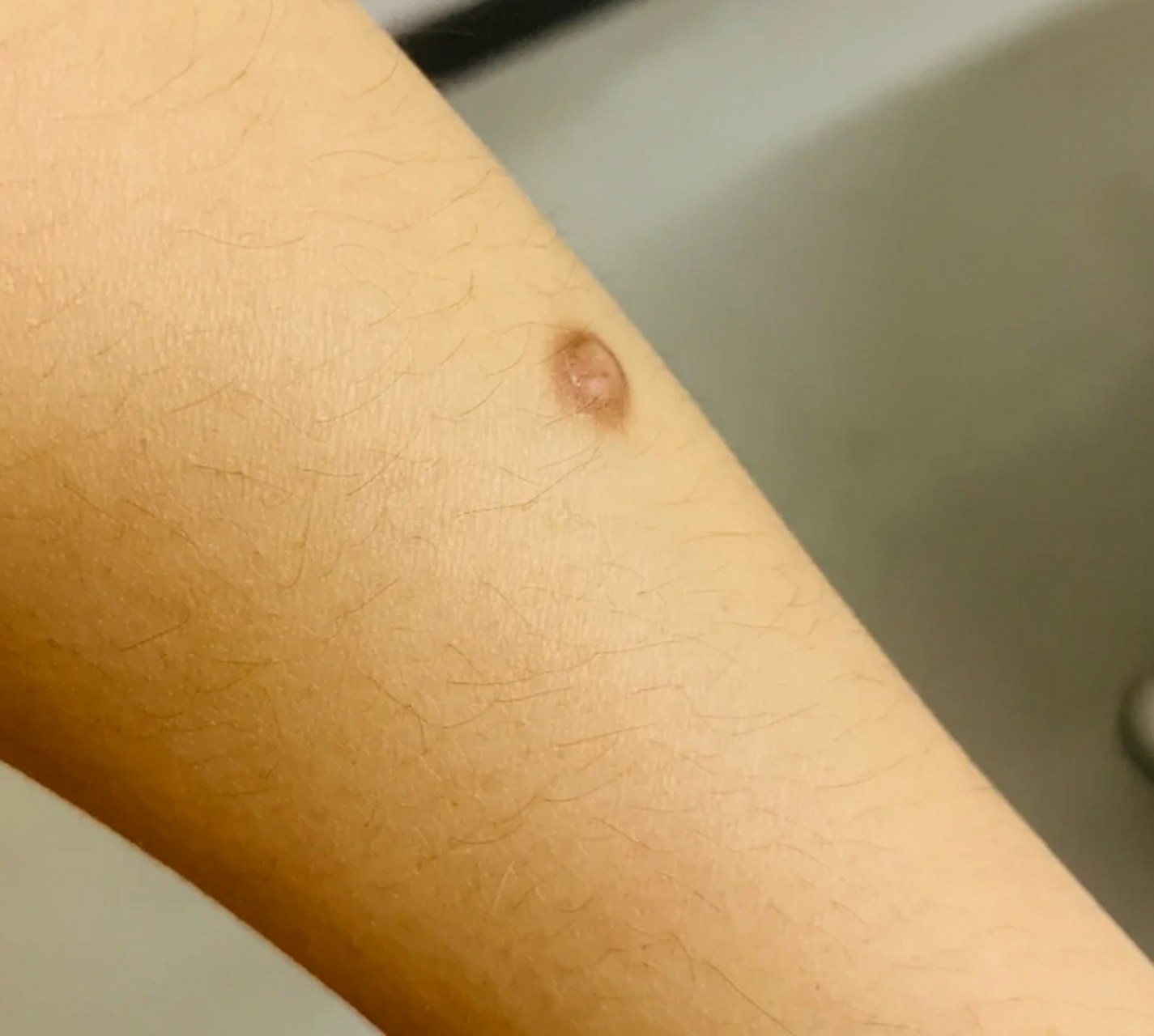 鱼鳞痣怎么去除 #医美科普挑战赛#  鱼鳞痣是一种常见的皮肤病变,通常