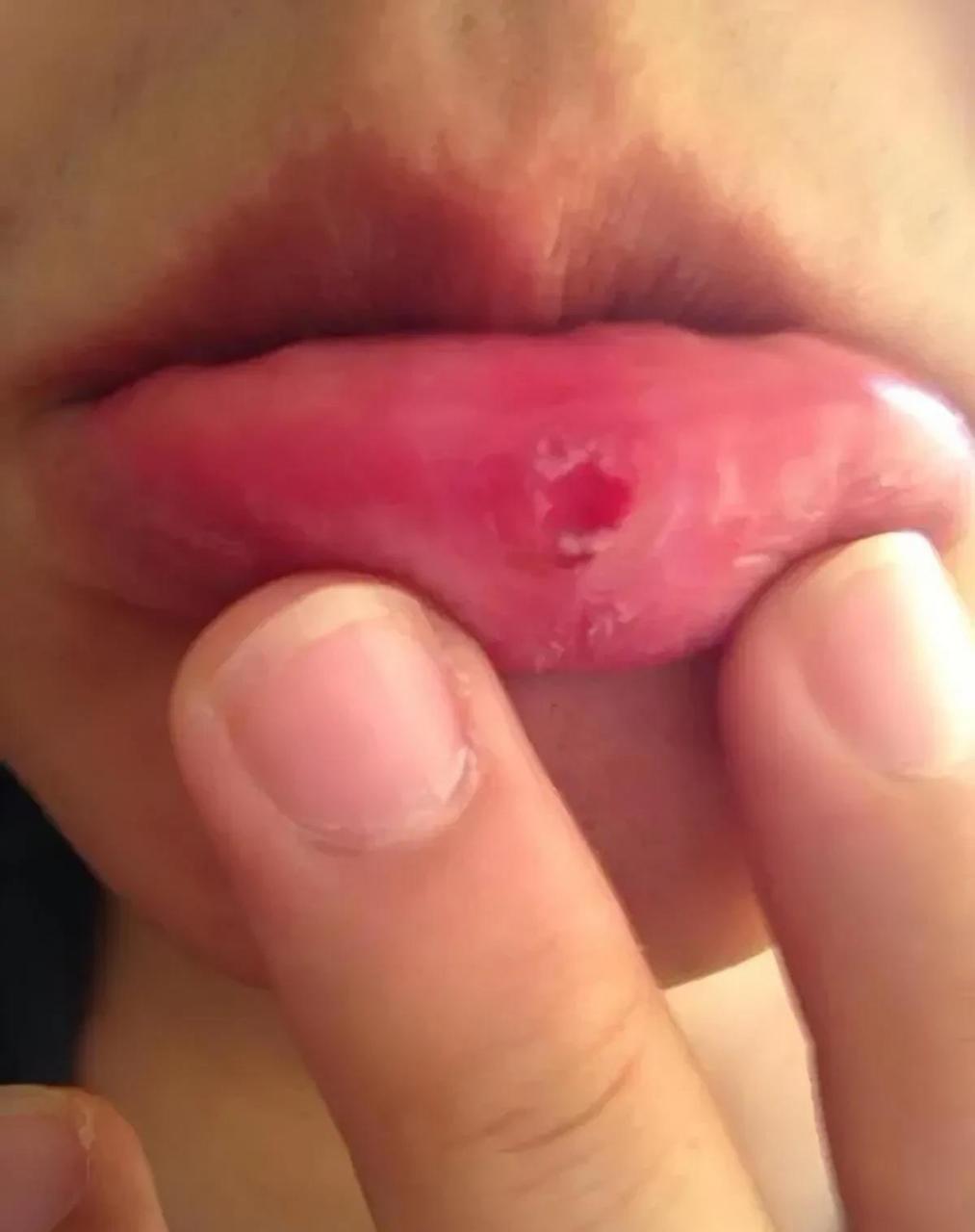 其口腔,外阴,肛门周围都可以见到一定硬度的疙瘩,类似于口腔溃疡,女子