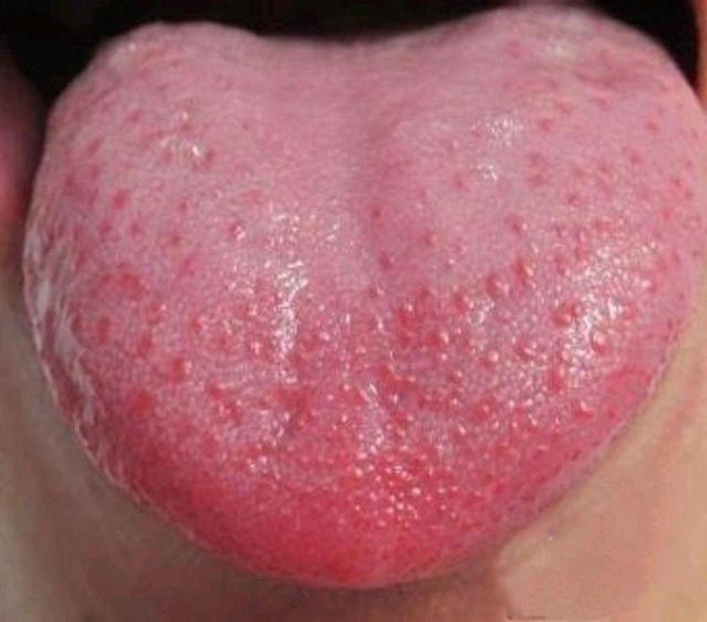 孩子的舌头发红,舌尖出现小红点,舌头看起来像是草莓