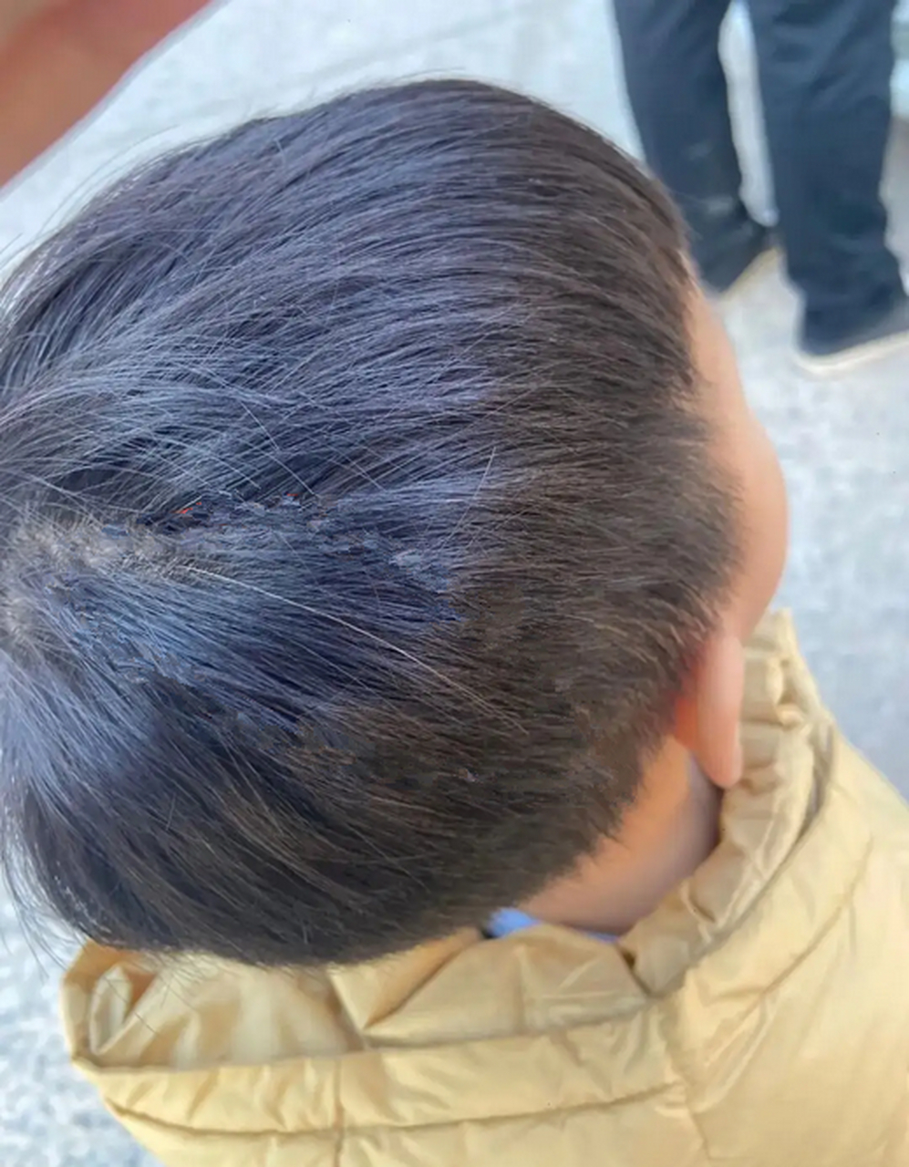 两岁的孩子有几根白发,怎么办?  宝宝出现白头发是正常的生理现象