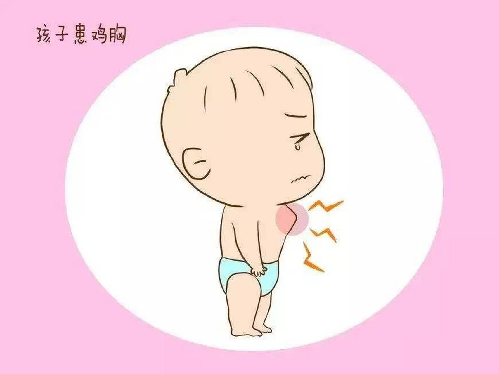 【鸡胸是因为宝宝缺钙吗?】  实际上通过补钙并不能治疗鸡胸.