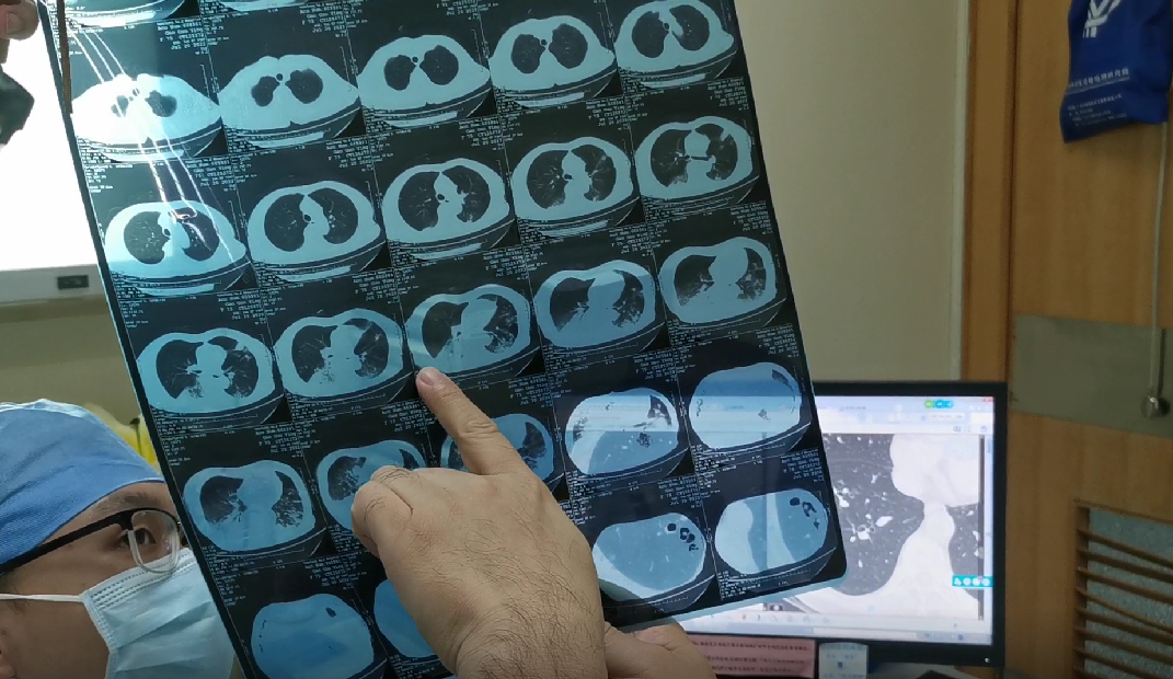 患者今年75岁,近期经常咳嗽并咳出大量痰