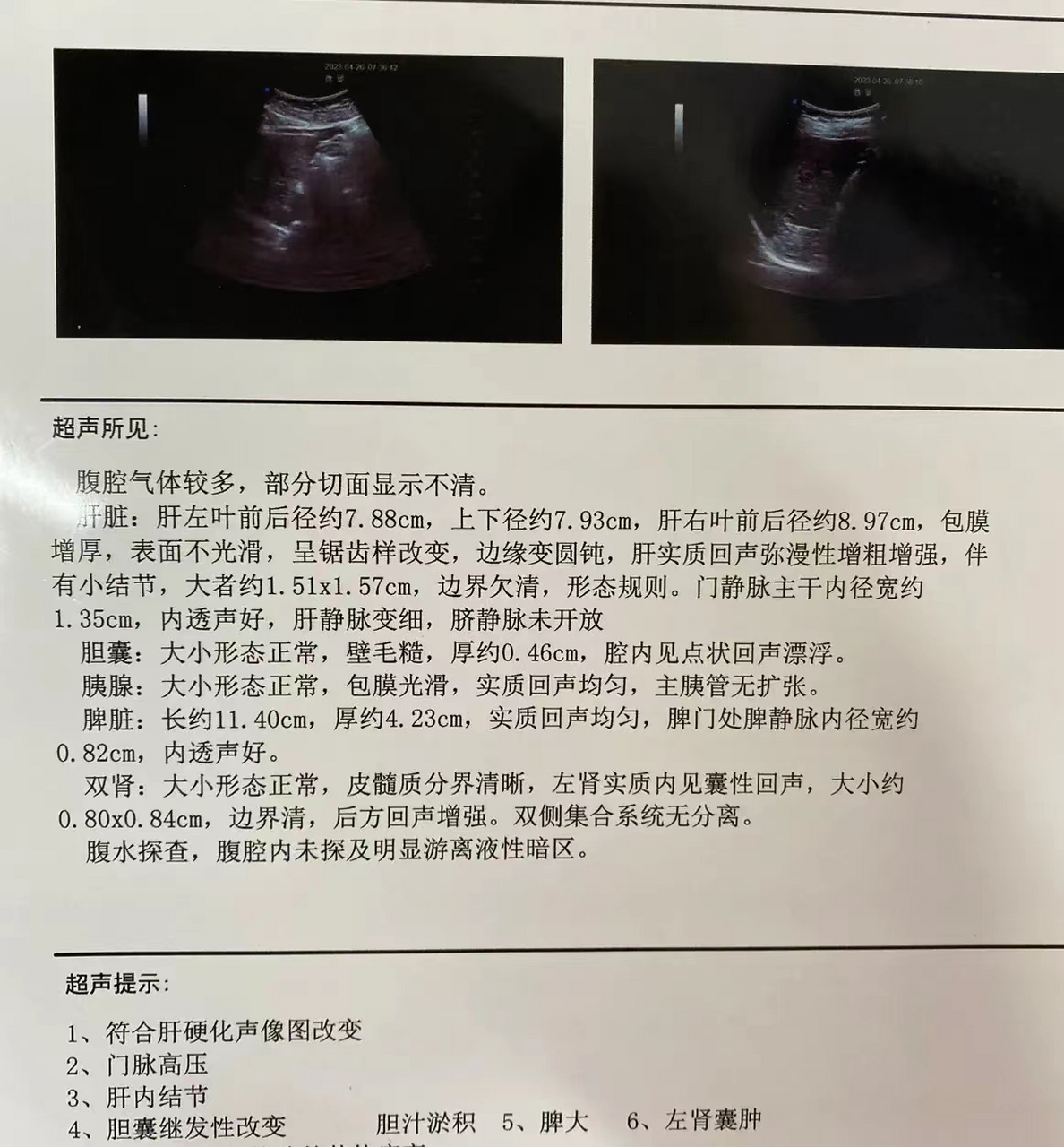 肝囊肿是体检或者平常做b超查的时候,b超上经常发现有肝囊肿,有黍候