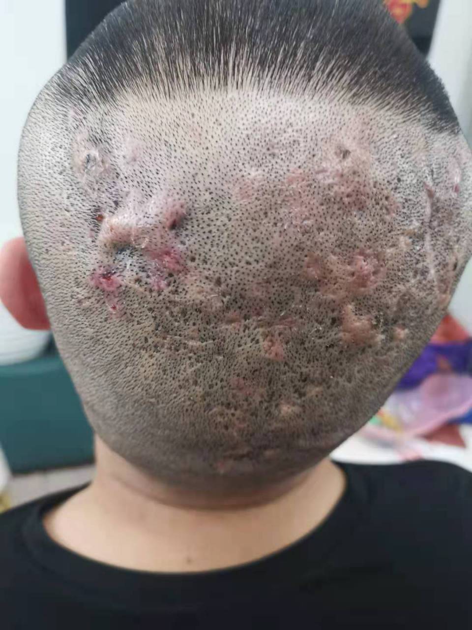 今天跟大家分享一个穿掘性毛囊炎的病例,这位患者说他夜晚睡觉不敢